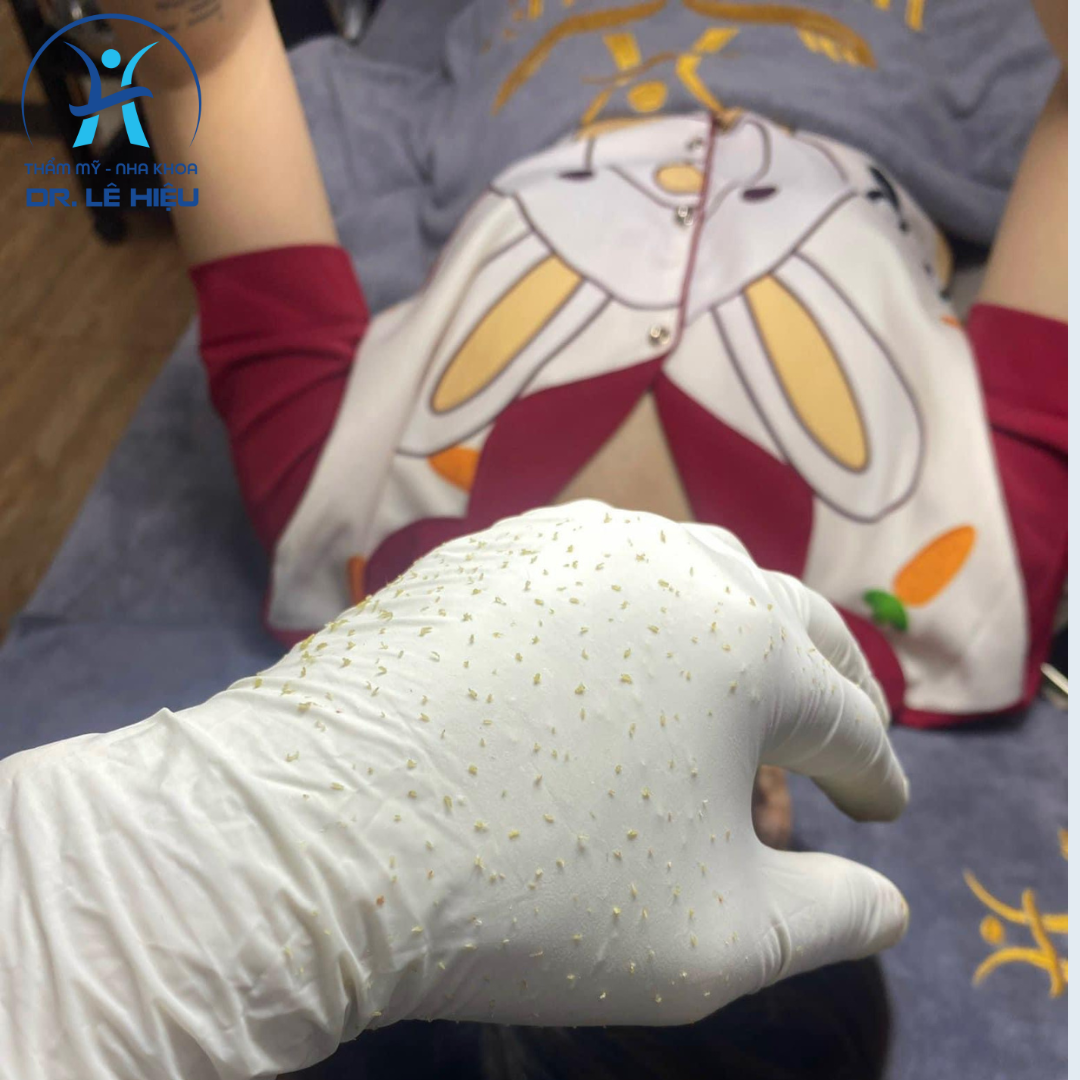 lay-nhan-mun-chuan-y-khoa-dr-le-hieu-binh-duong