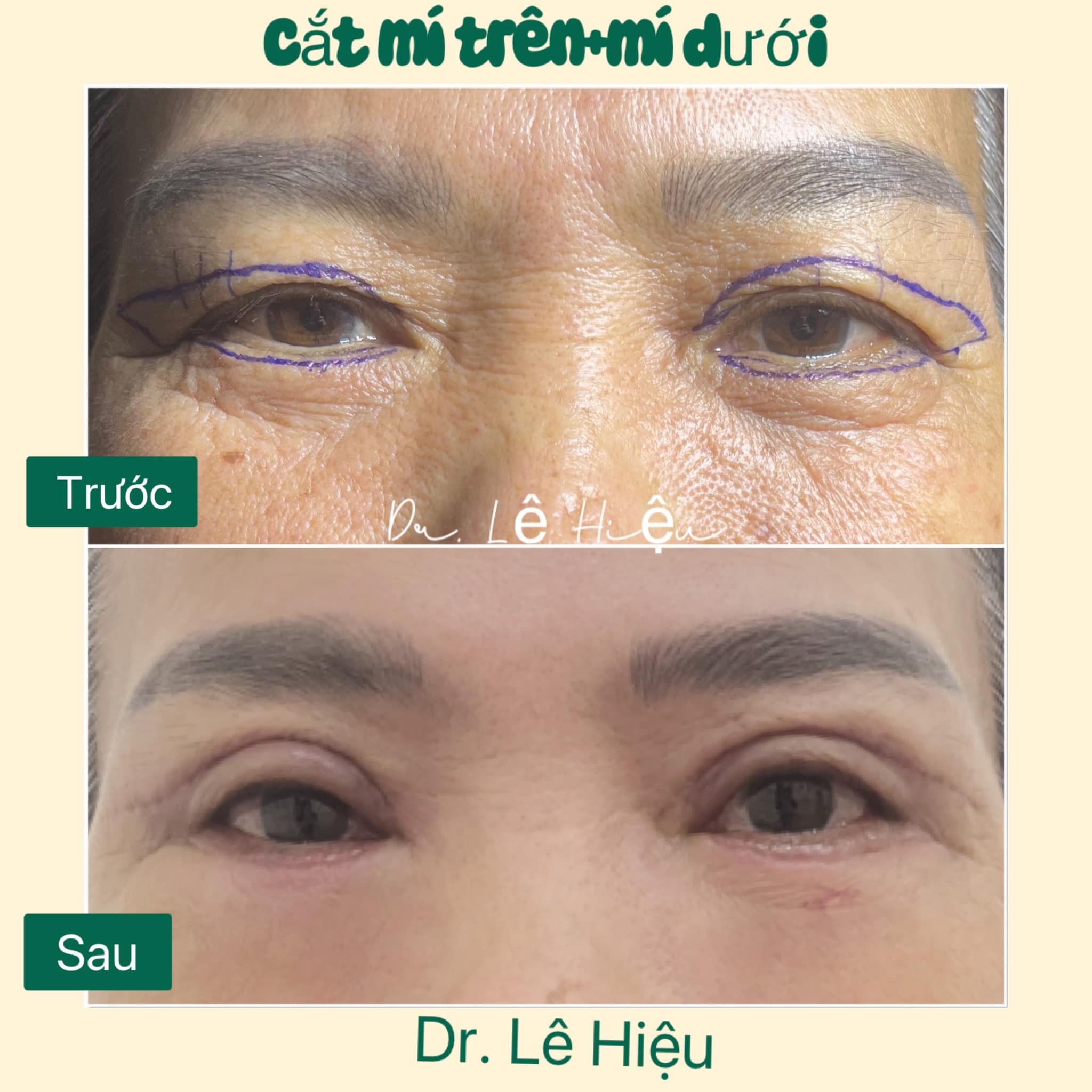 Cắt mí mắt và cách chăm sóc hiệu quả Phòng khám da liễu Dr Lê Hiệu