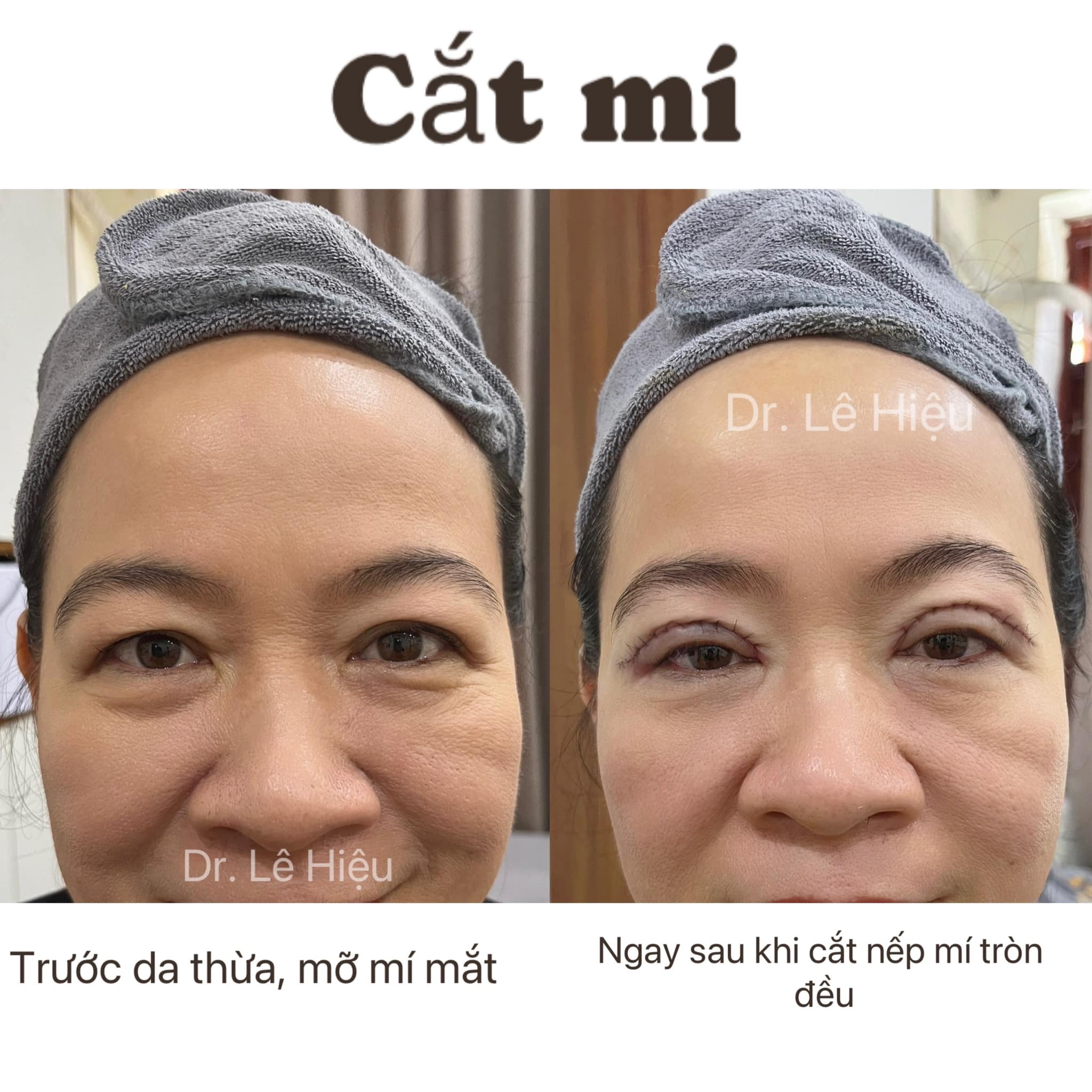 Cắt mí mắt và cách chăm sóc hiệu quả Phòng khám da liễu Dr Lê Hiệu