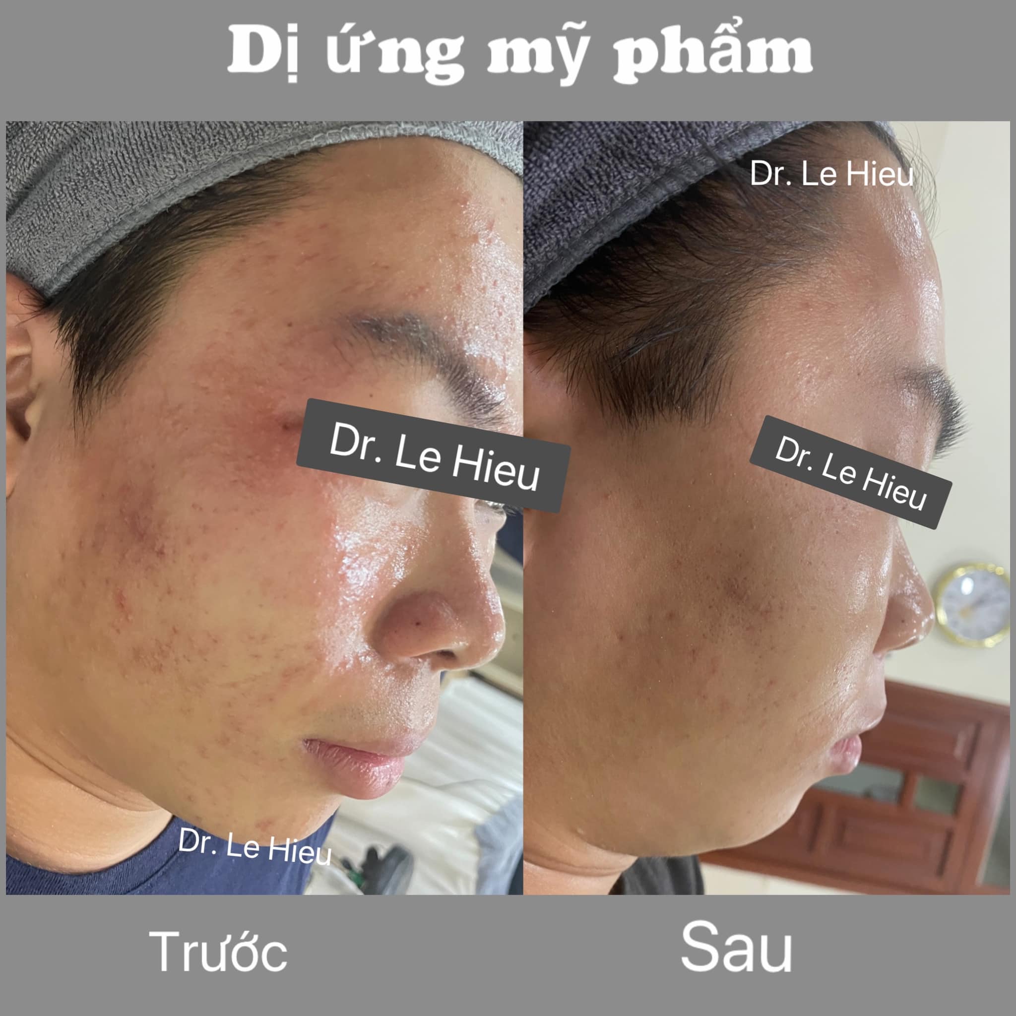 di-ung-da-khi-dang-dieu-tri-mun-phong-kham-da-lieu-dr-le-hieu Dị ứng da khi đang điều trị mụn phòng khám Da liễu Dr Lê Hiệu