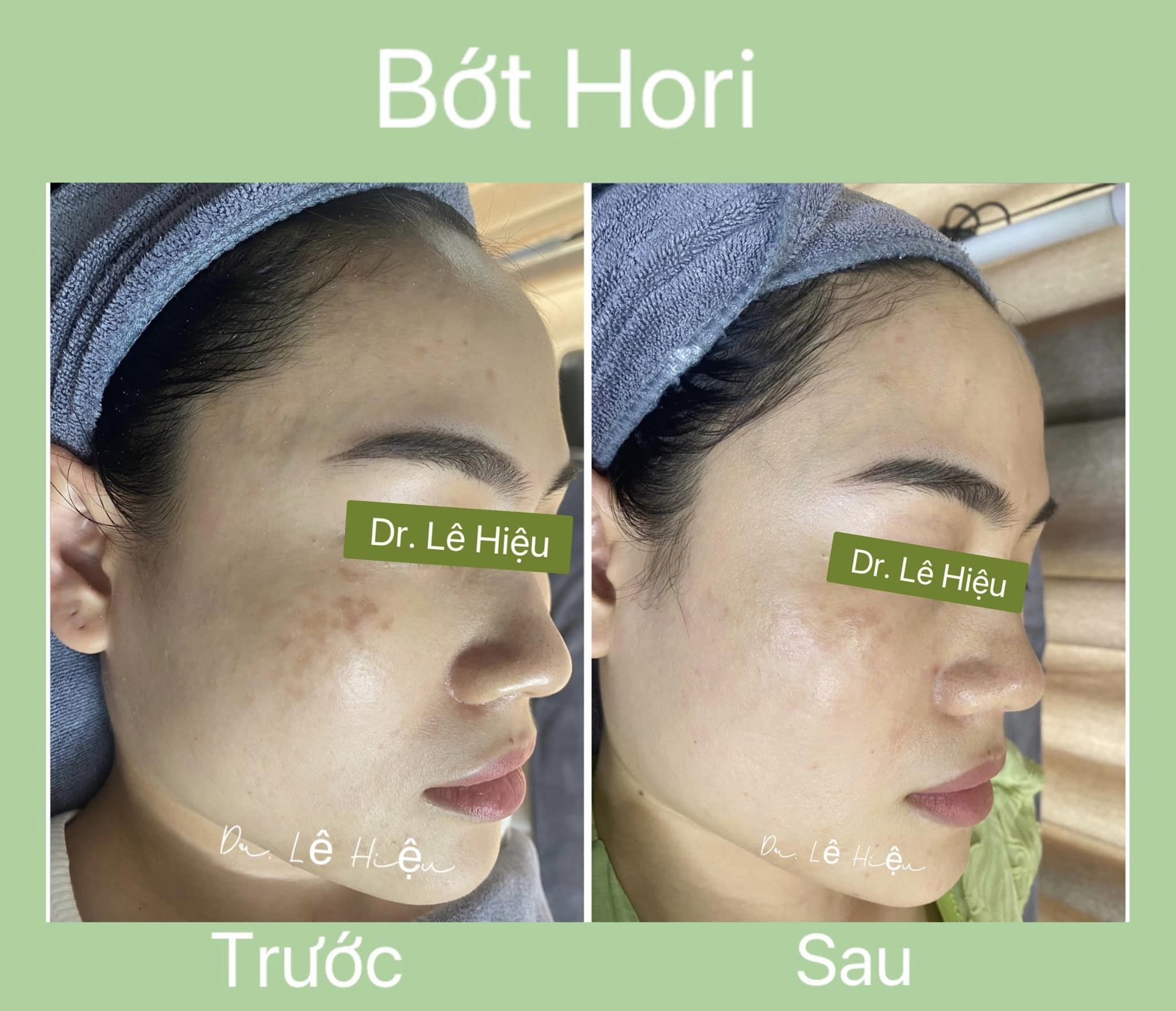 Điều trị bớt Hori - Phòng khám Da liễu Dr Lê Hiệu Vsip1 Bình Dương