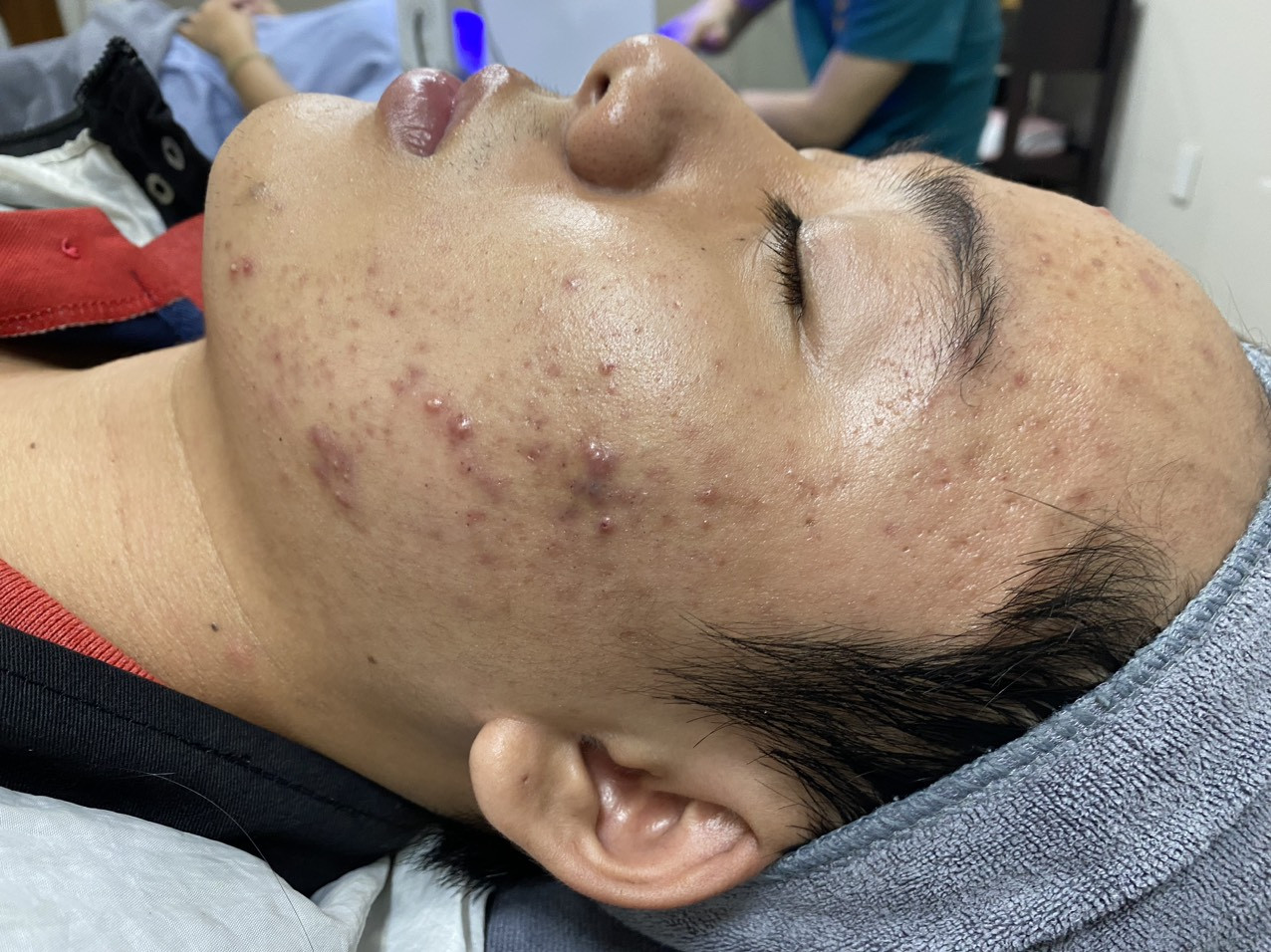 Điều trị mụn viêm phòng khám da liễu Dr Lê Hiệu Vsip 1