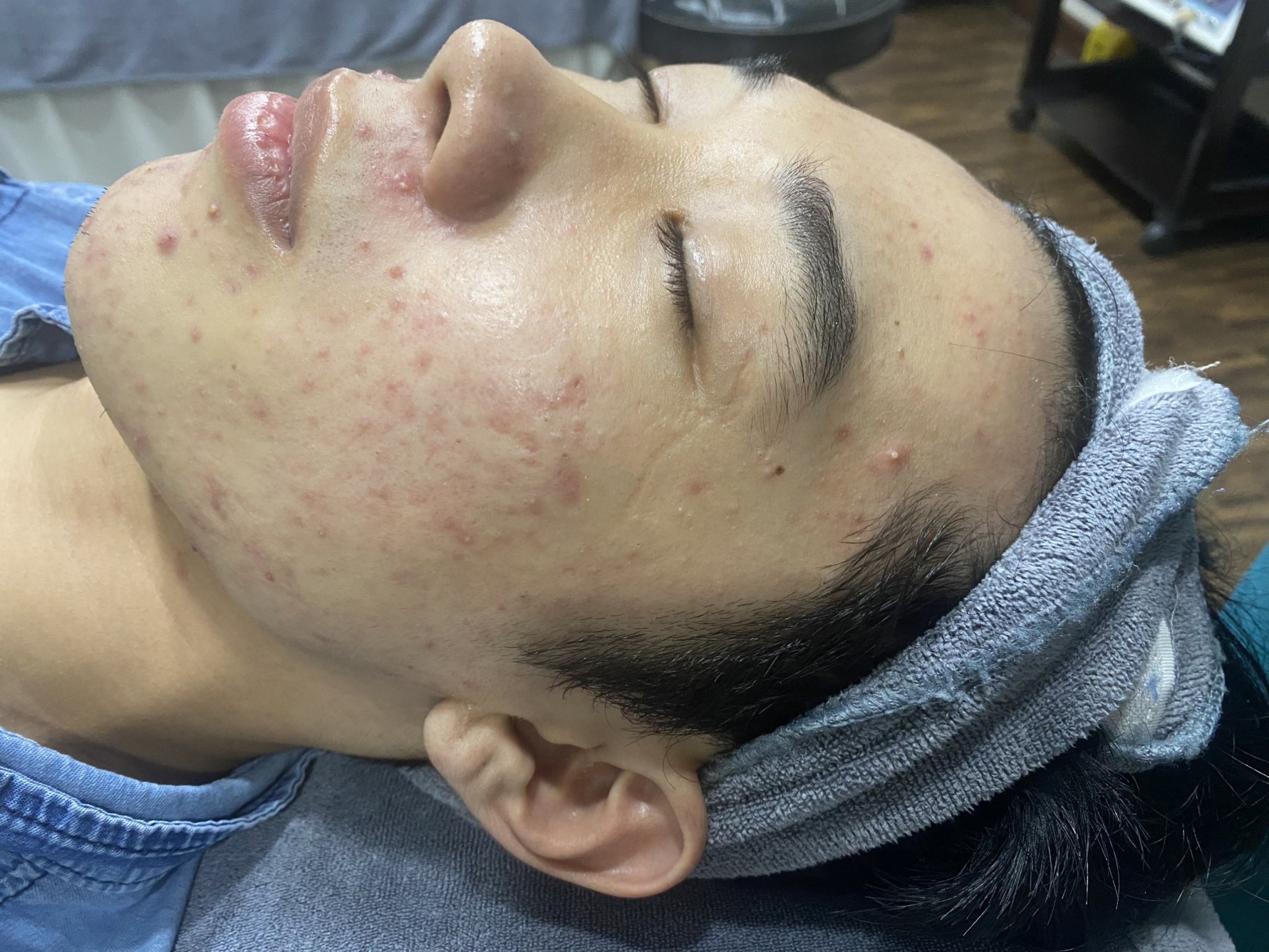 Điều trị mụn viêm phòng khám da liễu Dr Lê Hiệu Vsip 1