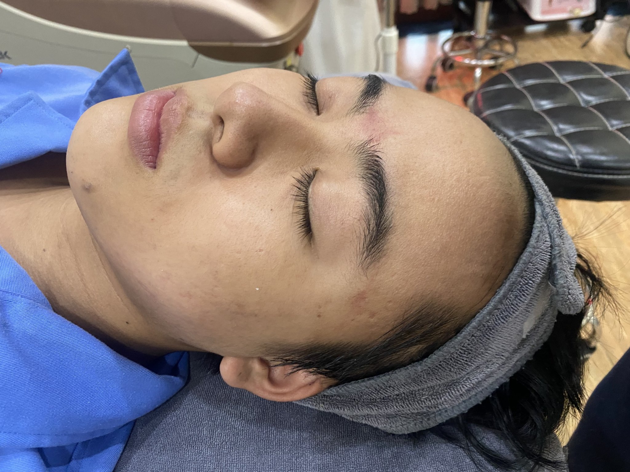 Điều trị mụn viêm phòng khám da liễu Dr Lê Hiệu Vsip 1