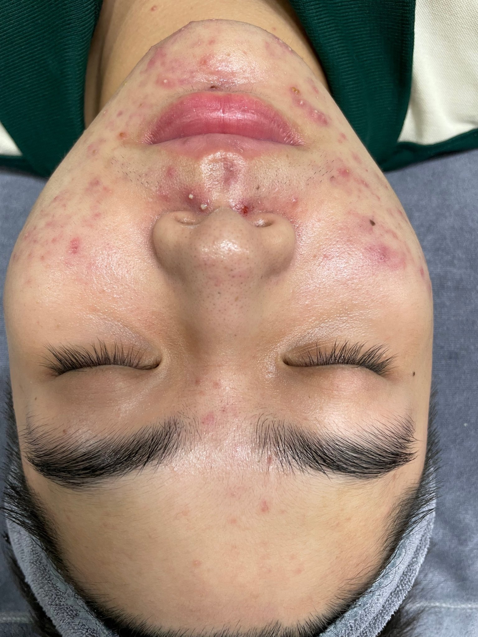 Mụn mọc nhiều ở cằm Phòng khám da liễu Dr Lê Hiệu