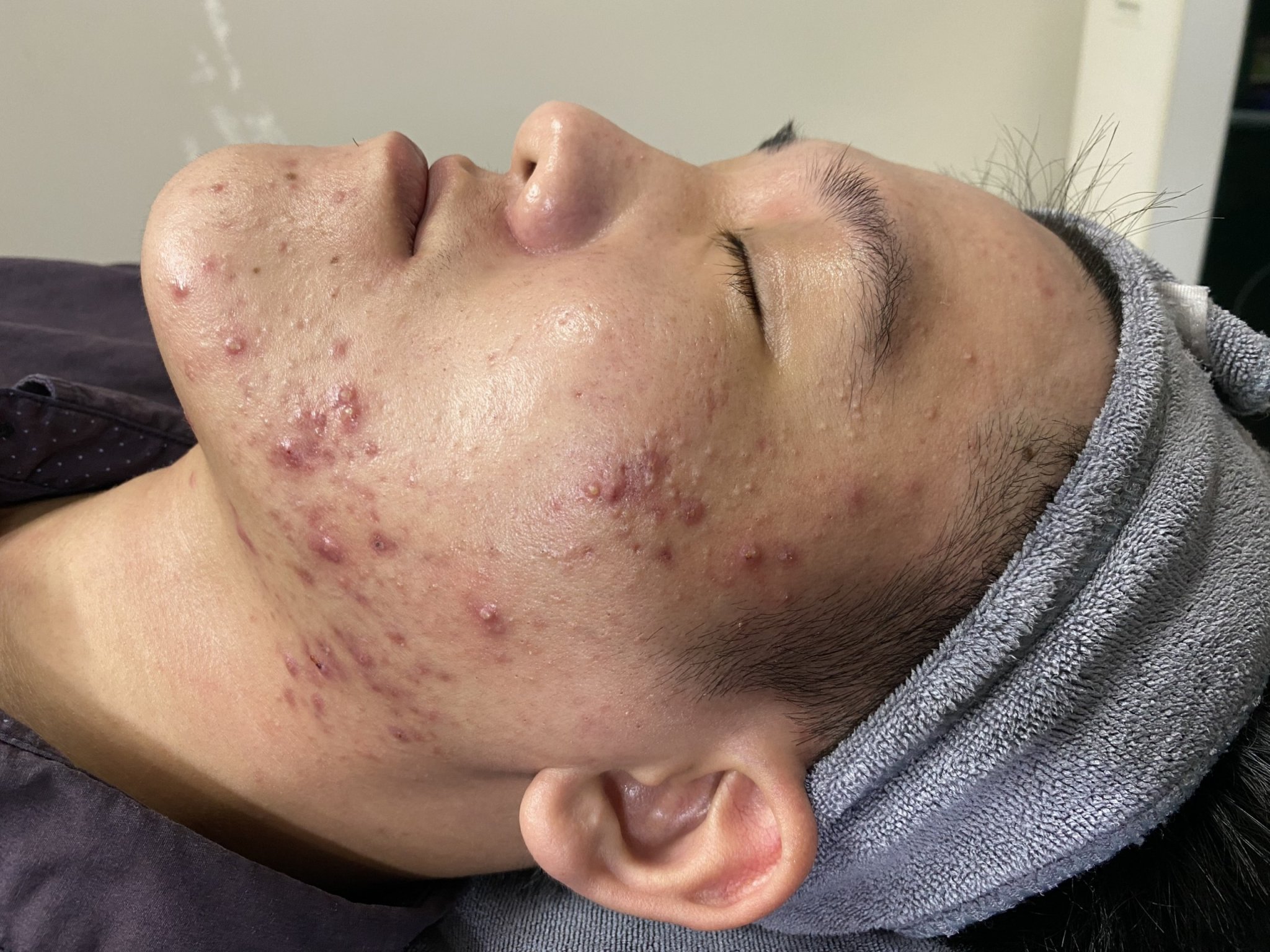 mun-moc-nhieu-o-cam-phong-kham-da-lieu-dr-le-hieu-2 Mụn mọc nhiều ở cằm Phòng khám da liễu Dr Lê Hiệu