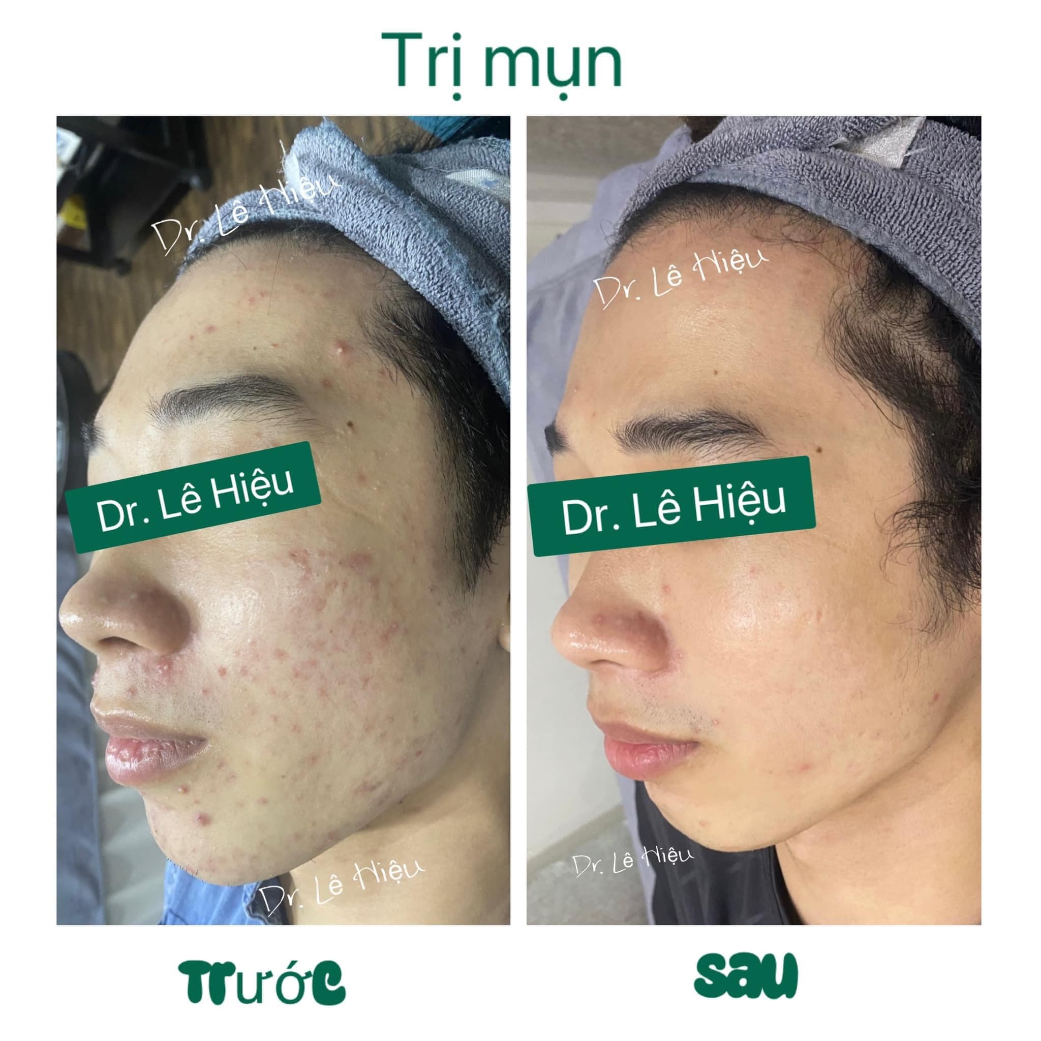 Peel da trị mụn có hiệu quả không Phòng khám Da liễu Dr Lê Hiệu