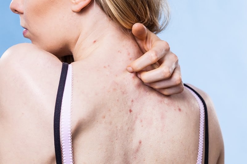 Nguyên nhân gây mụn lưng và cách điều trị mụn lưng