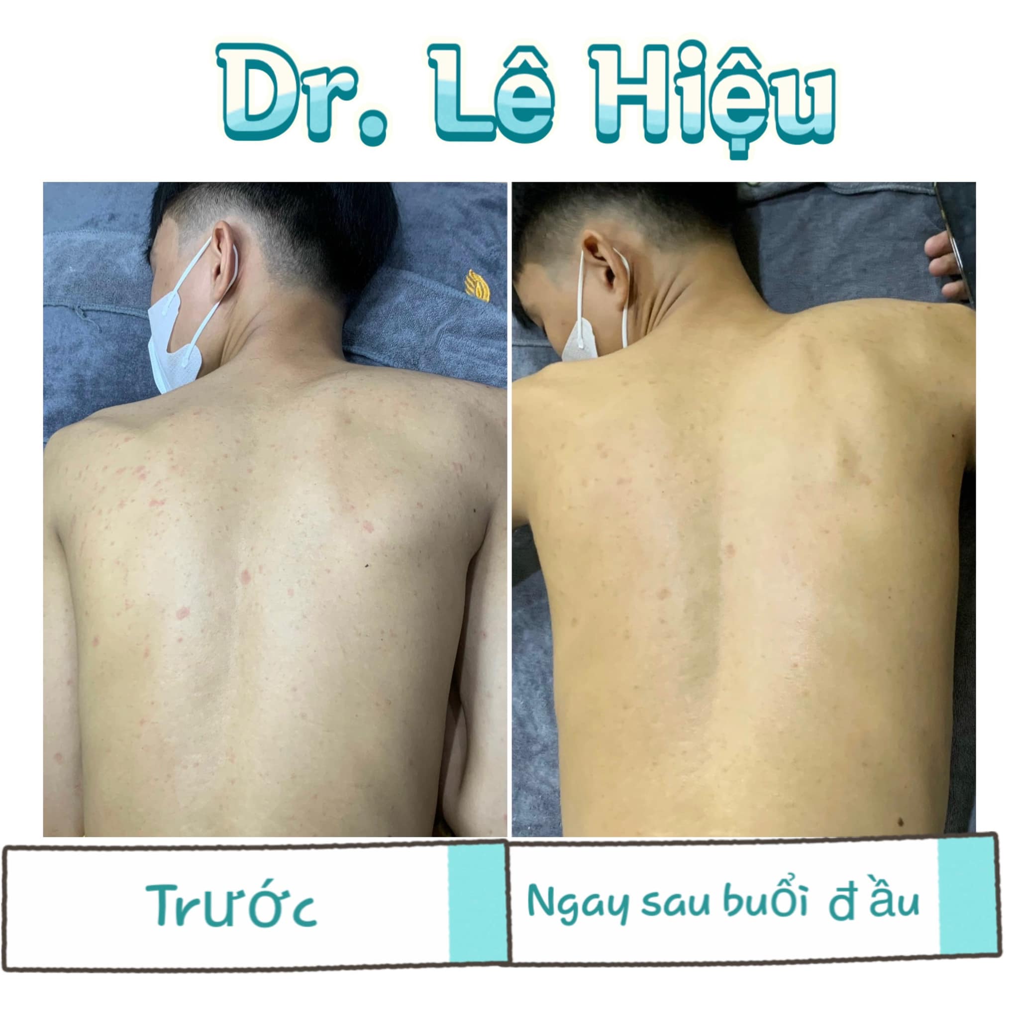 Nguyên nhân gây mụn lưng và cách điều trị mụn lưng