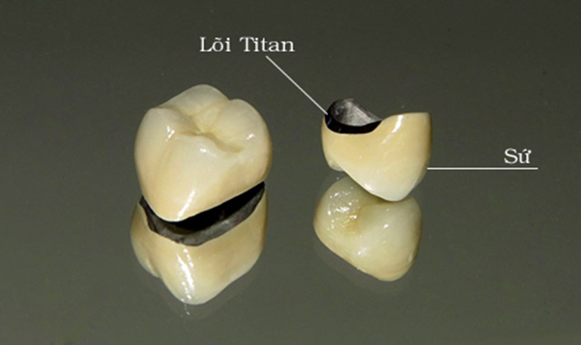 Răng sứ Titan Phòng khám Nha khoa Dr Lê Hiệu