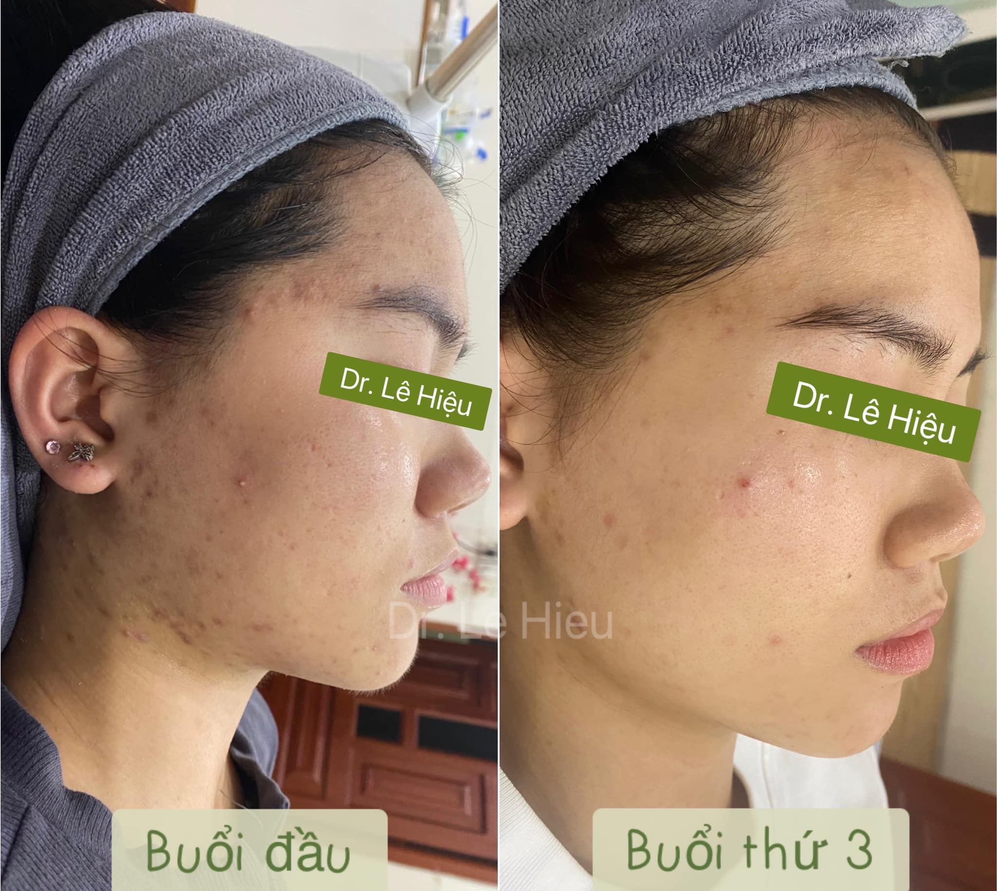 Tại sao nên lấy nhân mụn chuẩn y khoa? Phòng khám Da liễu Dr Lê Hiệu Thuận An Bình Dương