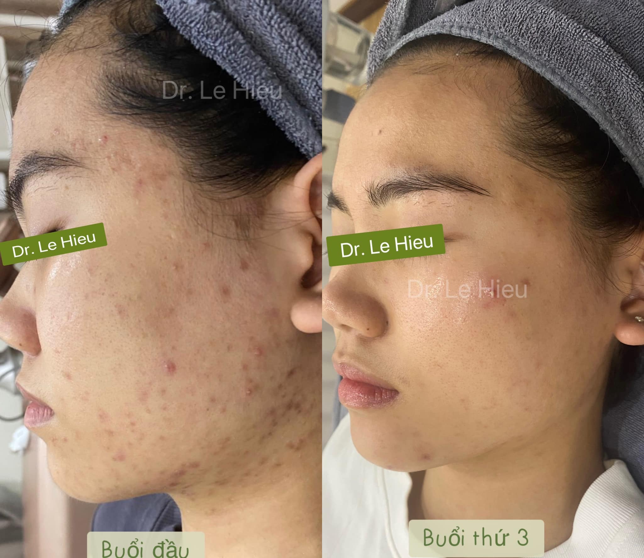 Tại sao nên lấy nhân mụn chuẩn y khoa? Phòng khám Da liễu Dr Lê Hiệu Thuận An Bình Dương