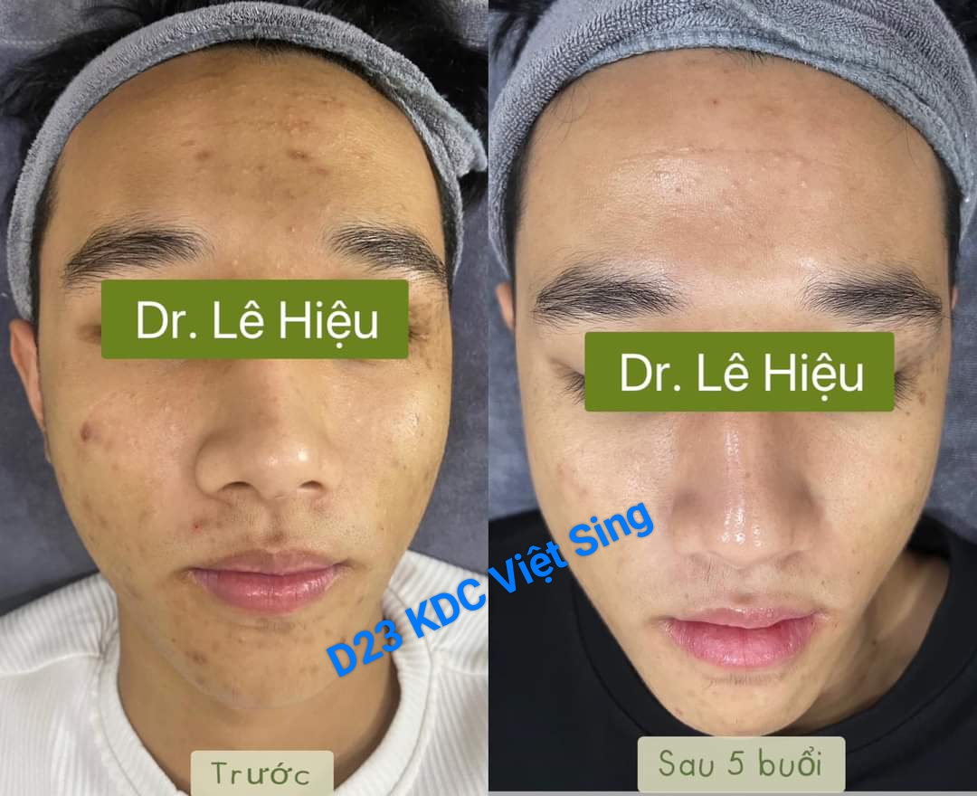 Cách trang điểm cho da mụn - Phòng khám Da liễu Dr Lê Hiệu Vsip 1 Bình Dương