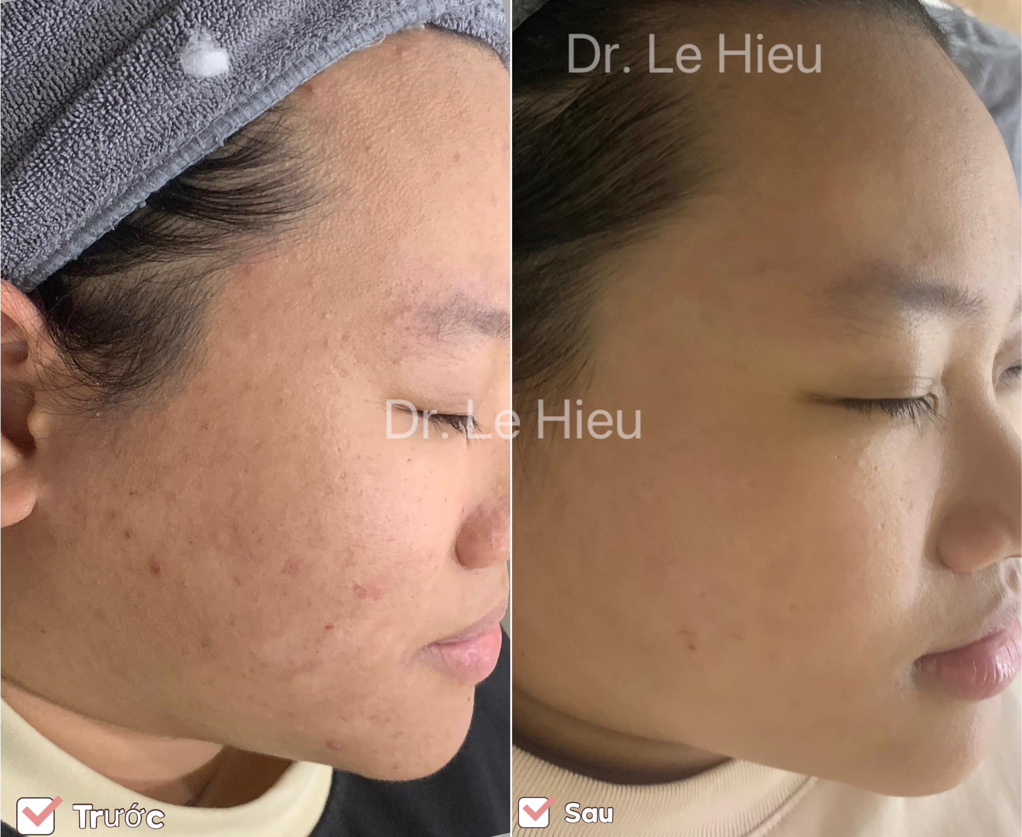 Bật mí cách skincare cho da mụn hiệu quả