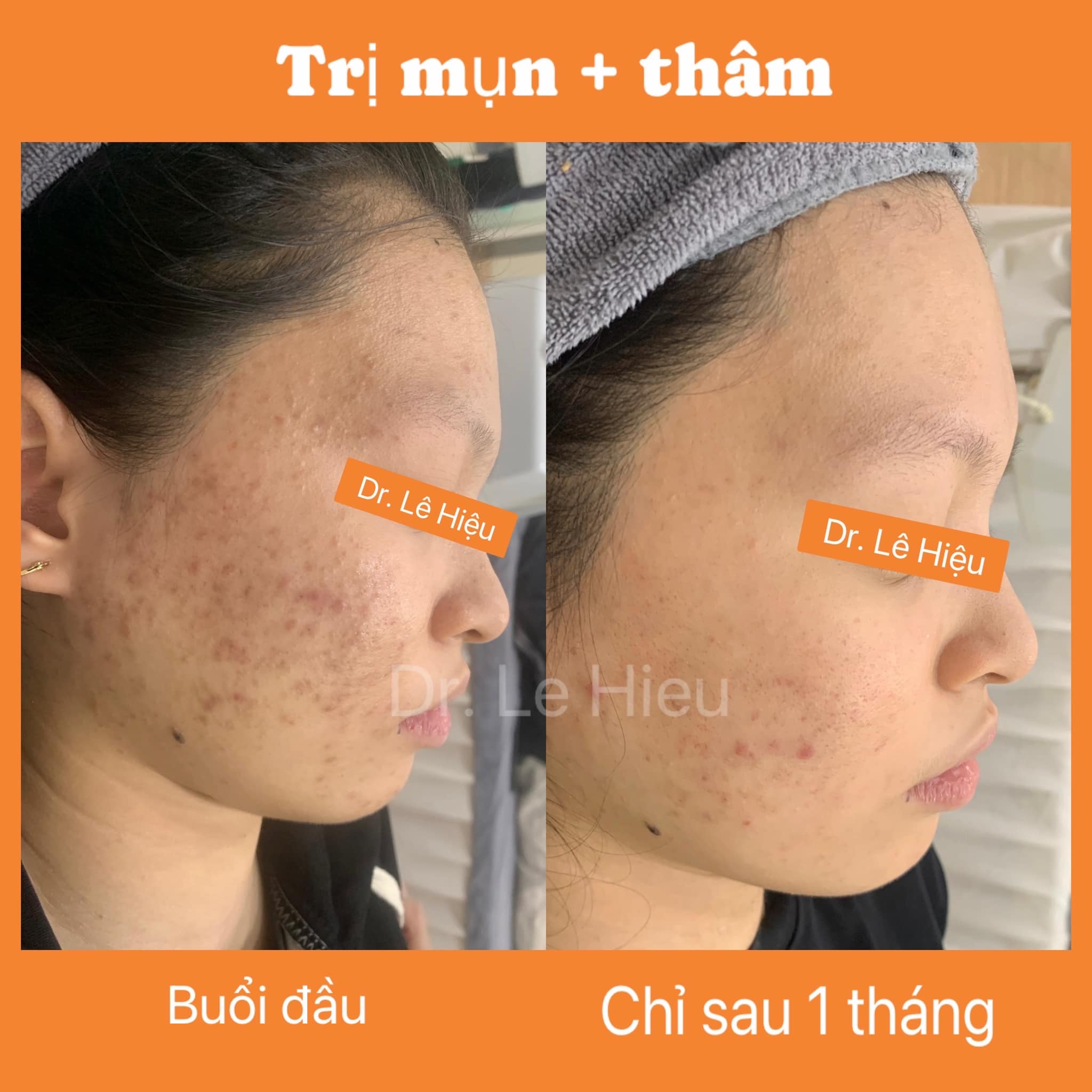 Bật mí cách skincare cho da mụn hiệu quả