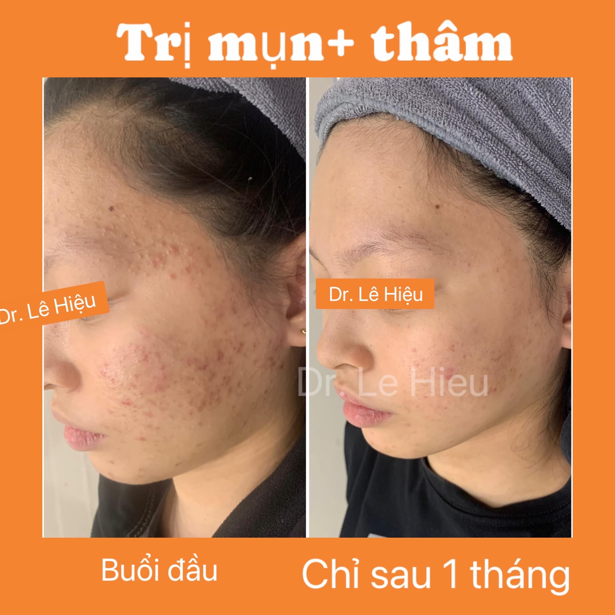 Bật mí cách skincare cho da mụn hiệu quả