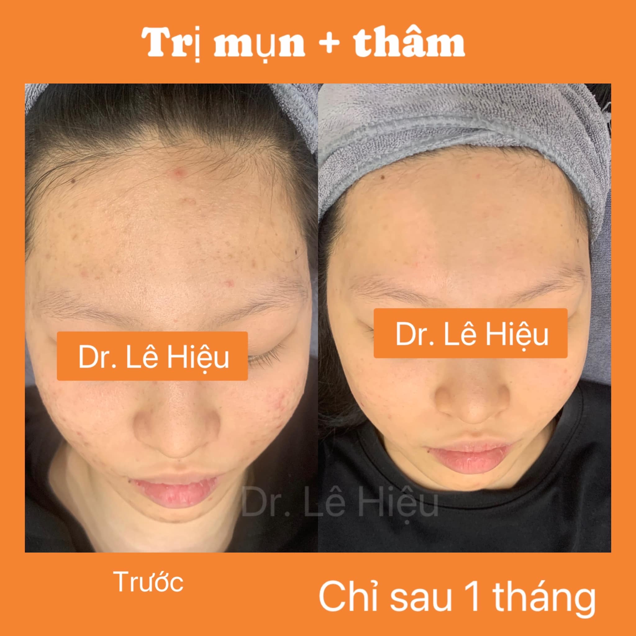 cach-skincare-cho-da-mun-hieu-qua Bật mí cách skincare cho da mụn hiệu quả
