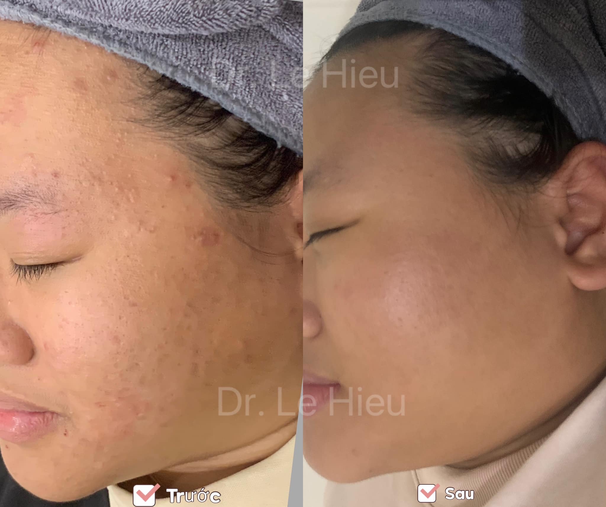 Bật mí cách skincare cho da mụn hiệu quả