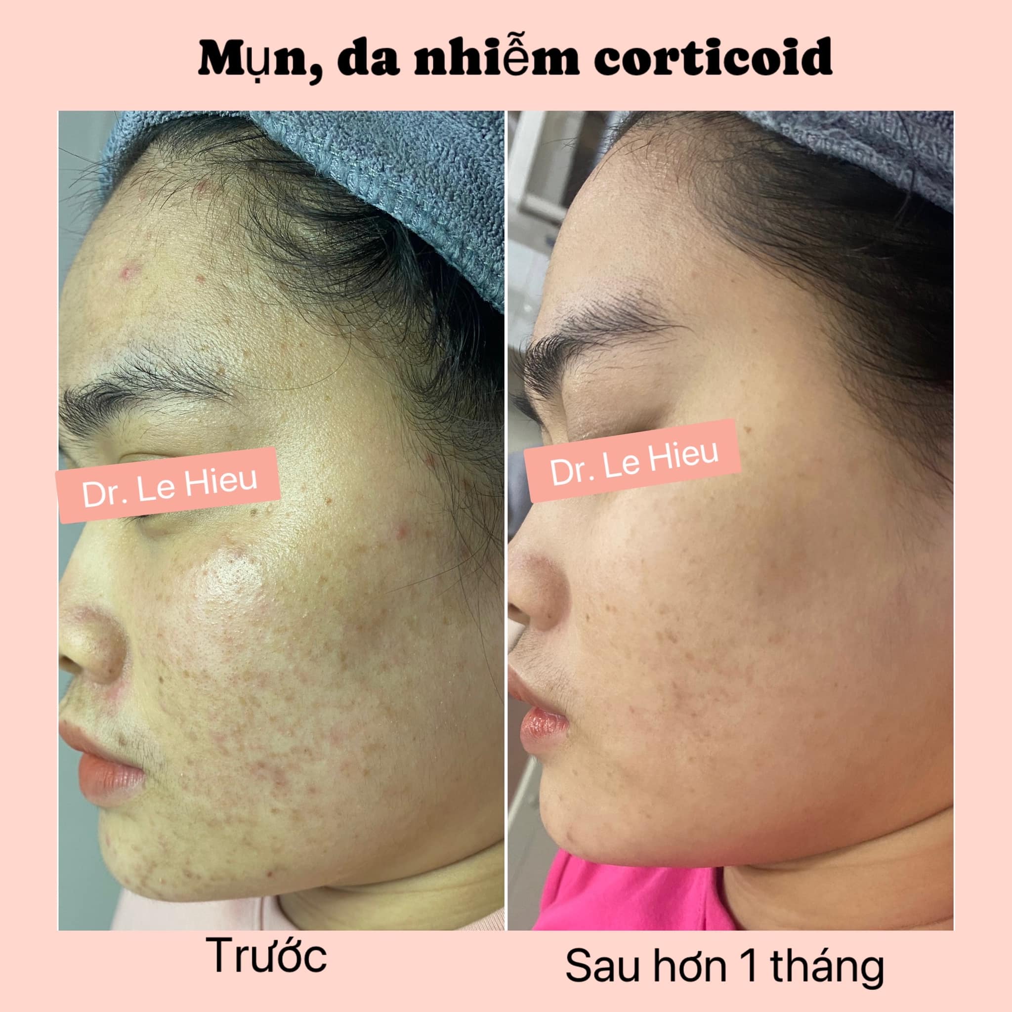 Tác dụng của Laser CO2 trong điều trị mụn Phòng khám da liễu Dr Lê Hiệu