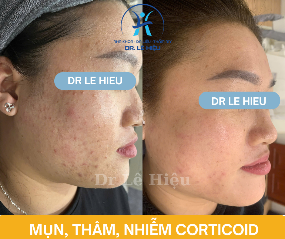 Phục hồi da nhiễm Corticoid Phòng khám Da liễu Dr Lê Hiệu Bình Dương