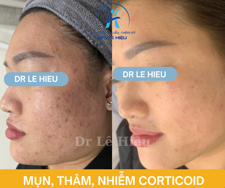 Phục hồi da nhiễm Corticoid Phòng khám Da liễu Dr Lê Hiệu Bình Dương