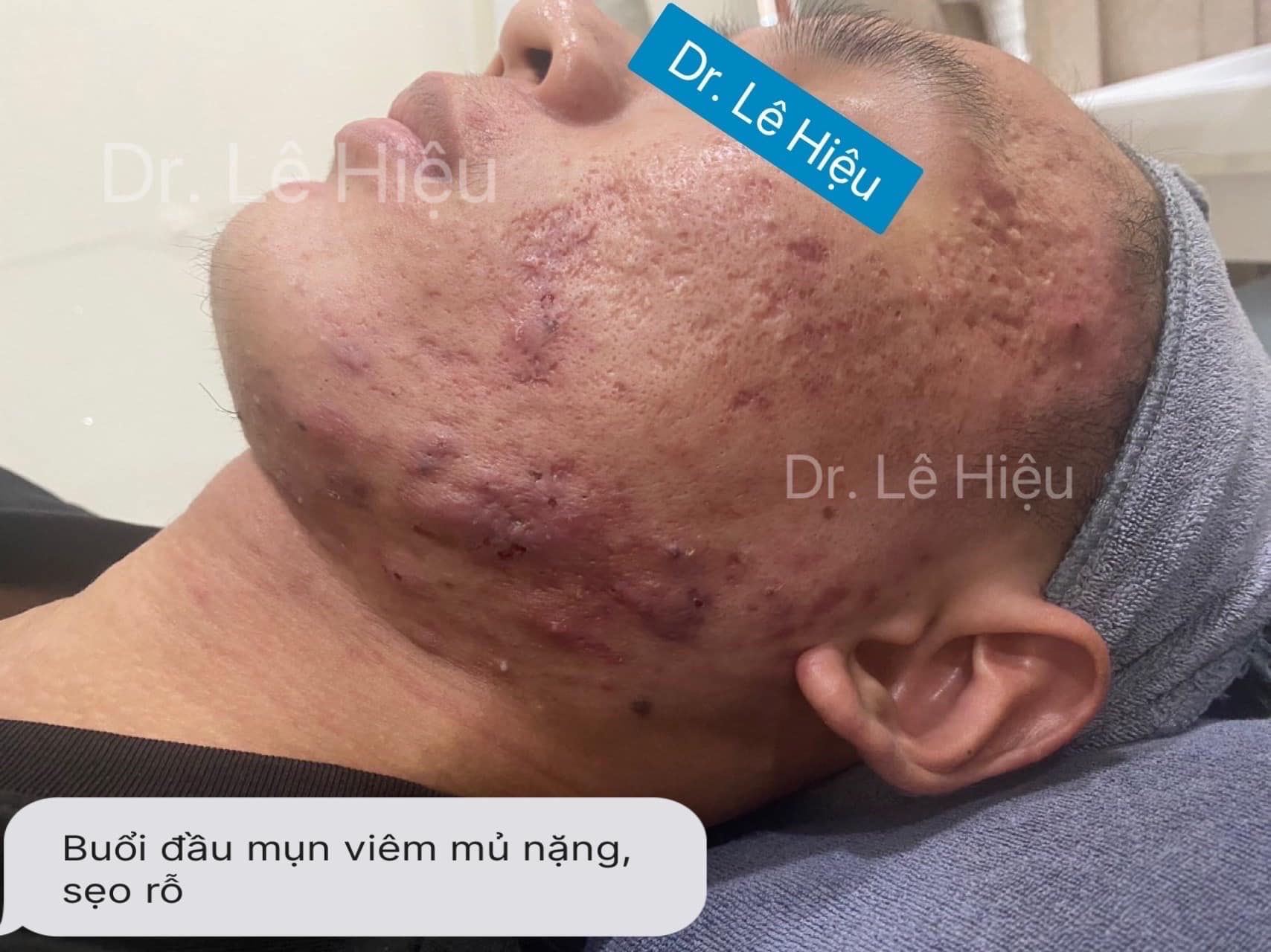 dieu-tri-seo-ro-dr-le-hieu-binh-duong Dấu hiệu cần điều trị sẹo rỗ sớm Phòng khám Da liễu Dr Lê Hiệu Bình Dương