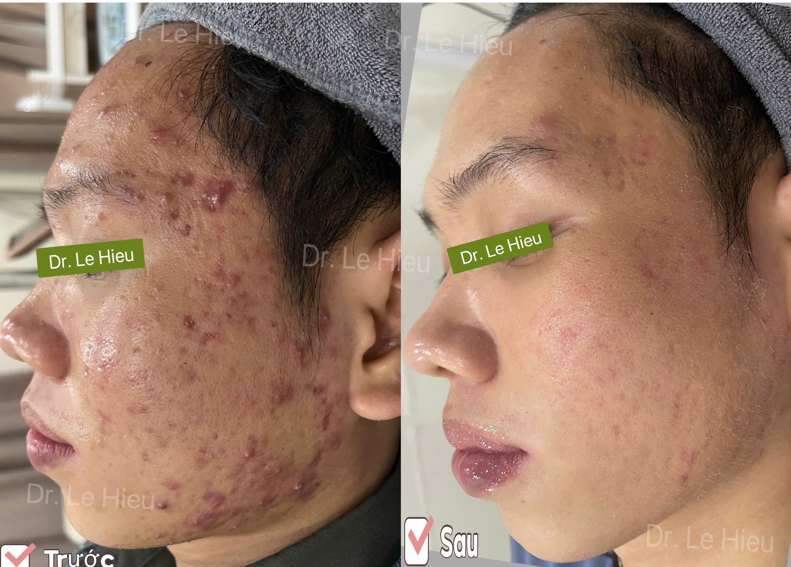 Điều trị mụn viêm có dễ không? Phòng khám Da liễu Dr Lê Hiệu Bình Dương