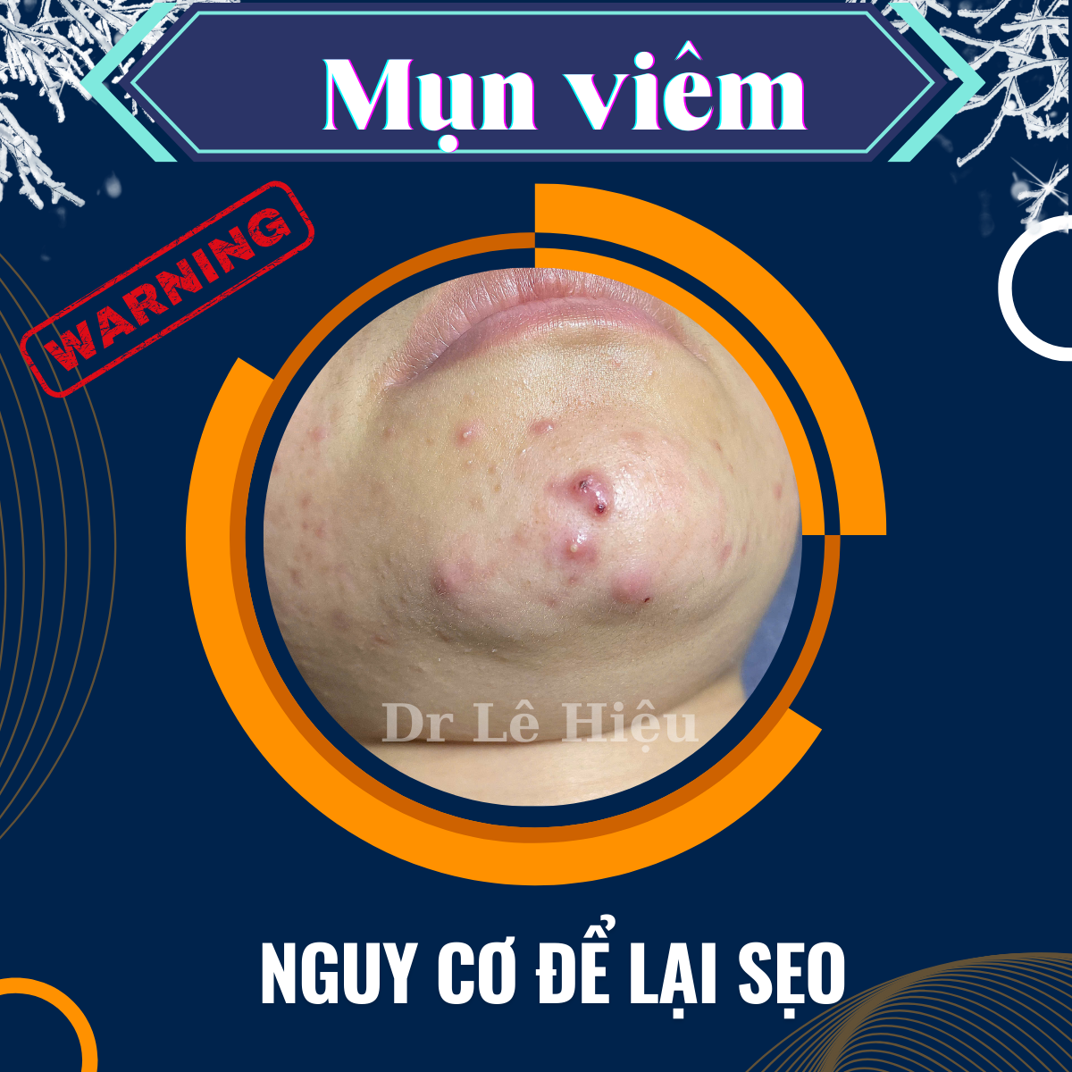Những điều cần biết về mụn viêm Phòng khám Da liễu Dr Lê Hiệu
