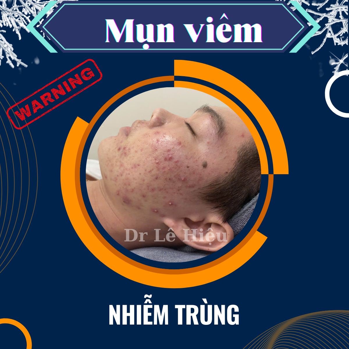 Những điều cần biết về mụn viêm Phòng khám Da liễu Dr Lê Hiệu