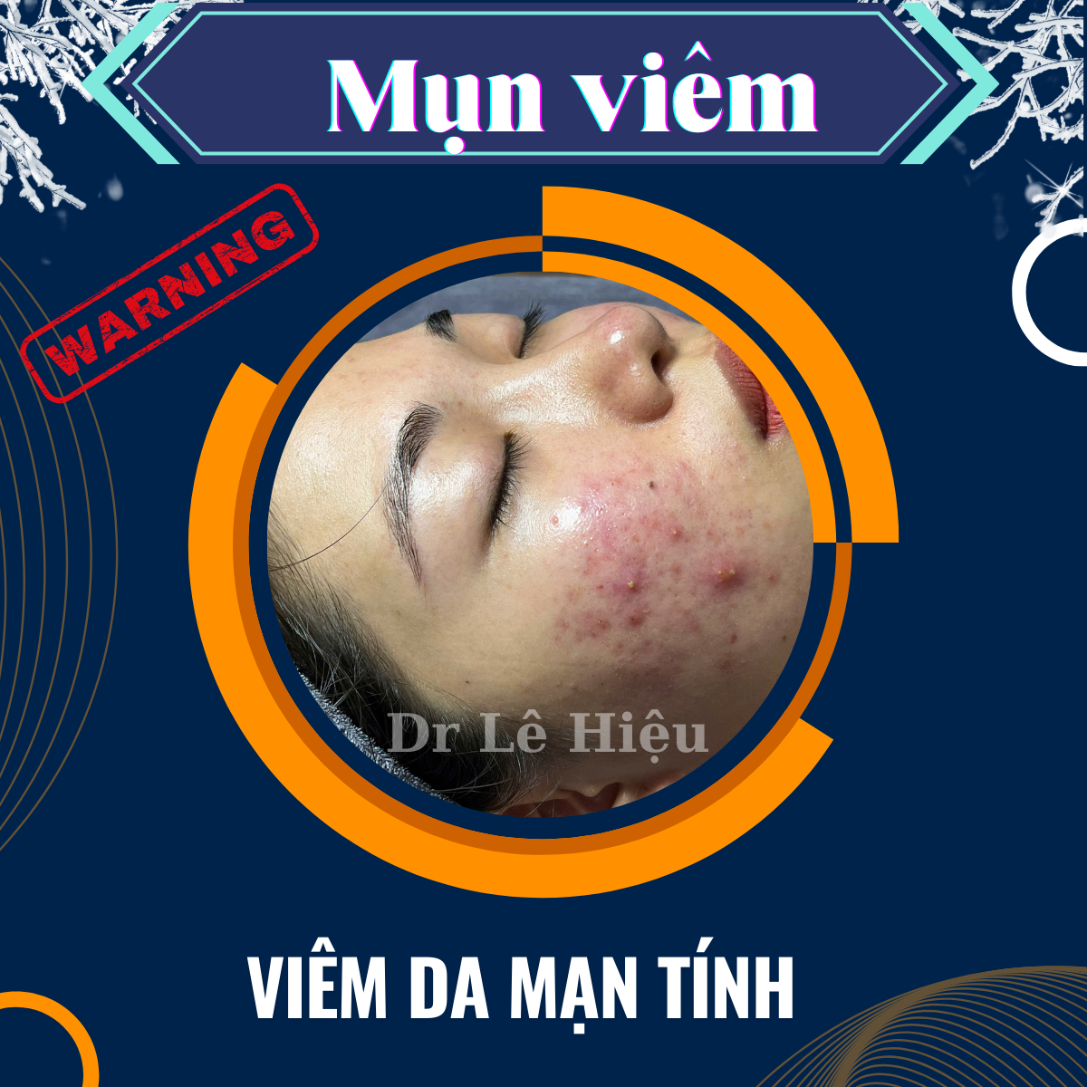 Những điều cần biết về mụn viêm Phòng khám Da liễu Dr Lê Hiệu