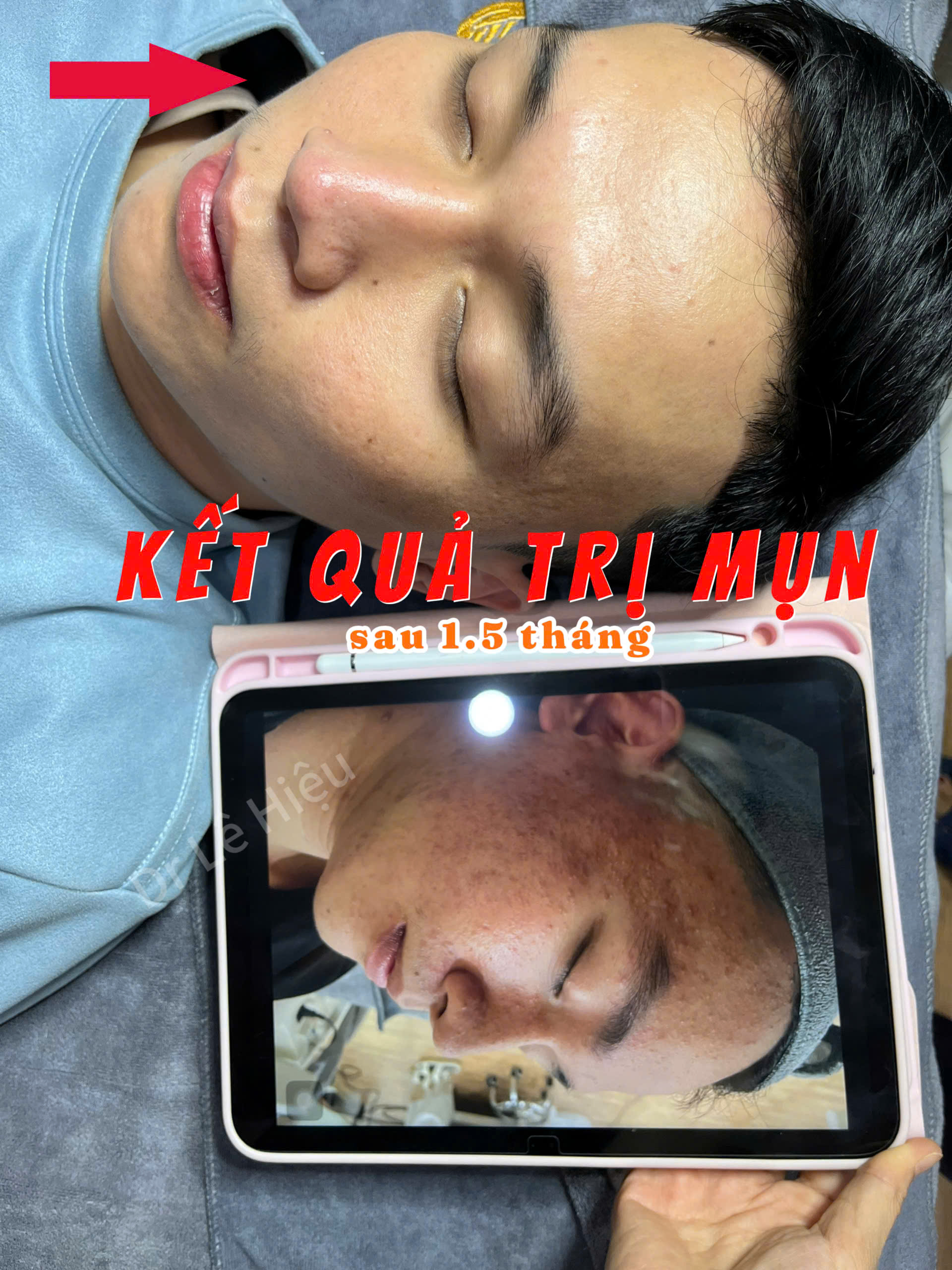 Tại sao cần điều trị mụn viêm bằng công nghệ IPL?