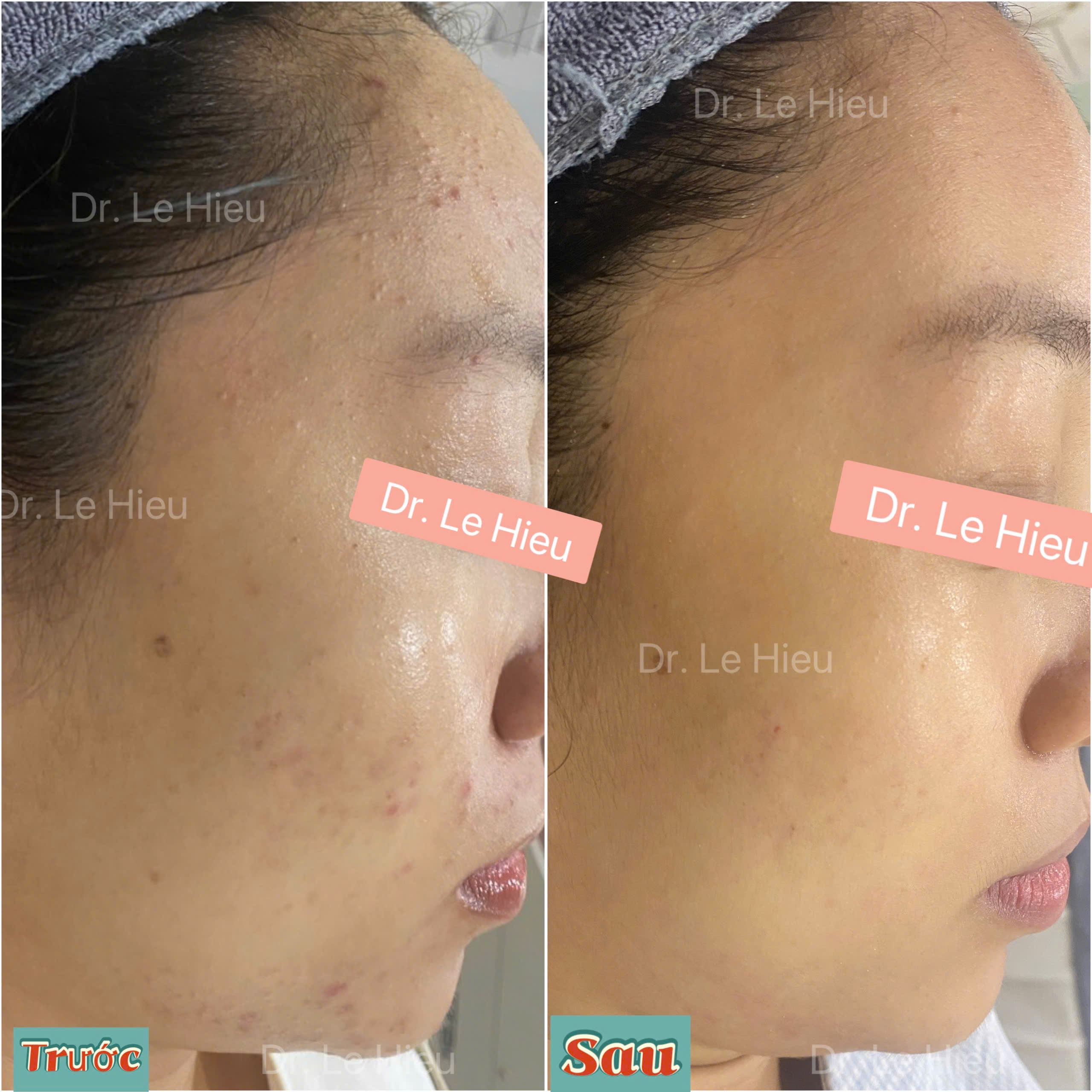 Bít tắc cổ nang lông