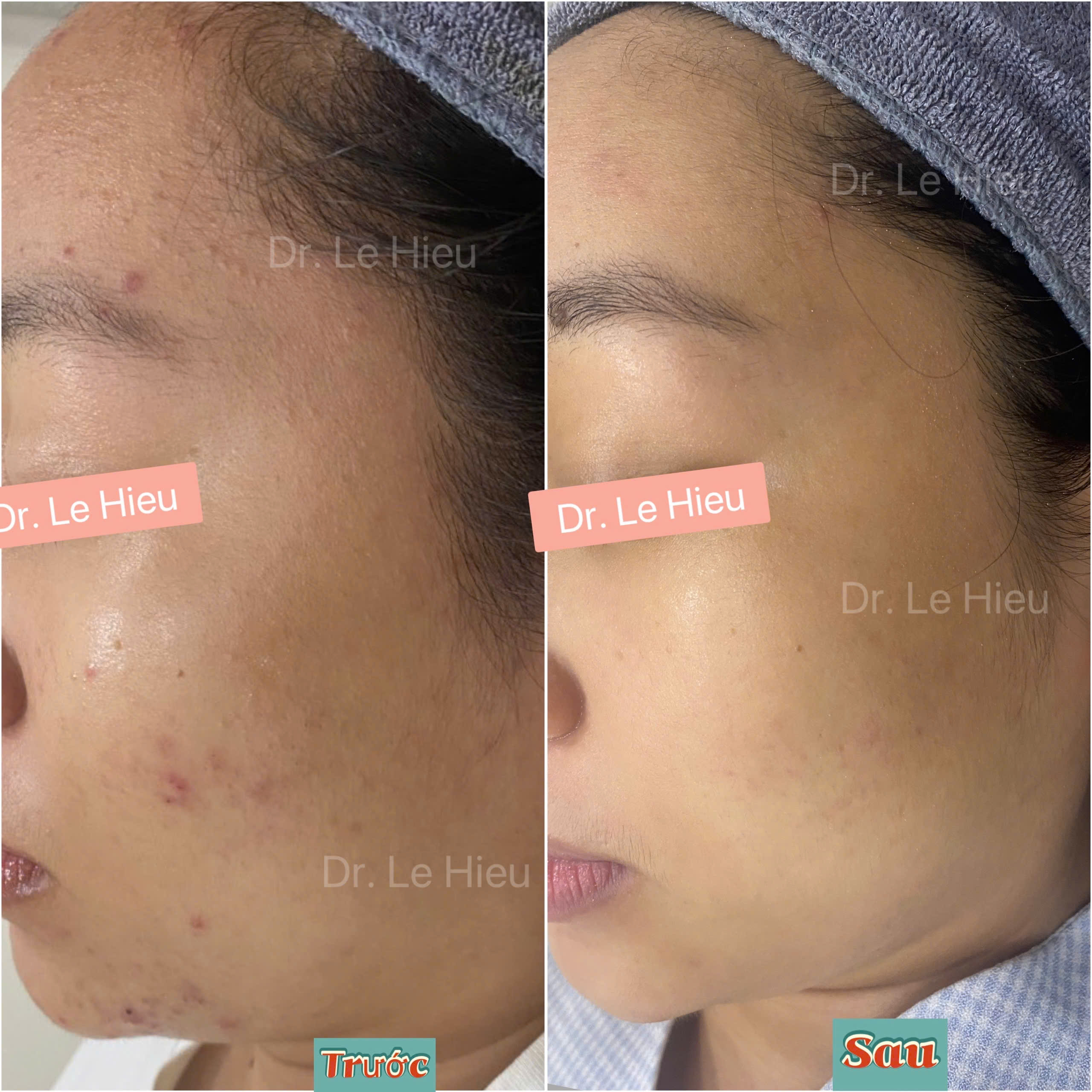 bit-tac-co-nang-long Bít tắc cổ nang lông