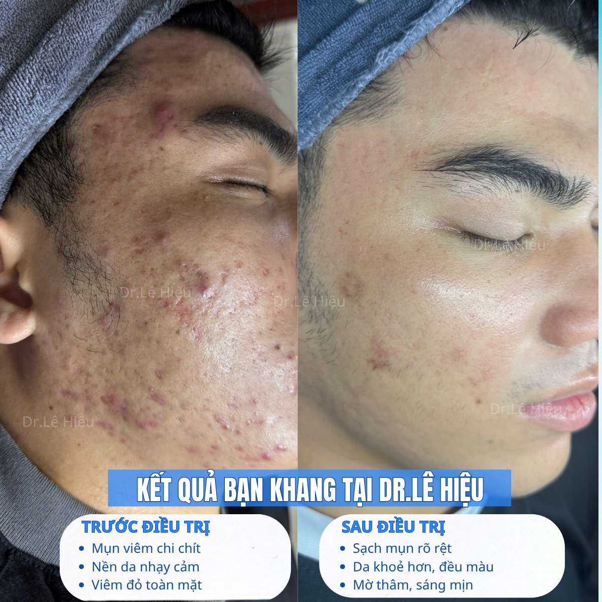 Kết quả sau điều trị mụn viêm tại Dr.Lê Hiệu cơ sở Bình Dương (góc phải)