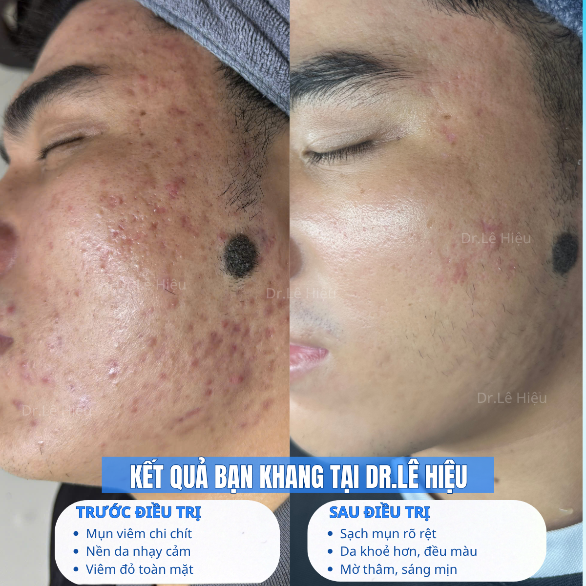 Kết quả sau điều trị mụn viêm tại Dr.Lê Hiệu cơ sở Bình Dương (góc trái)