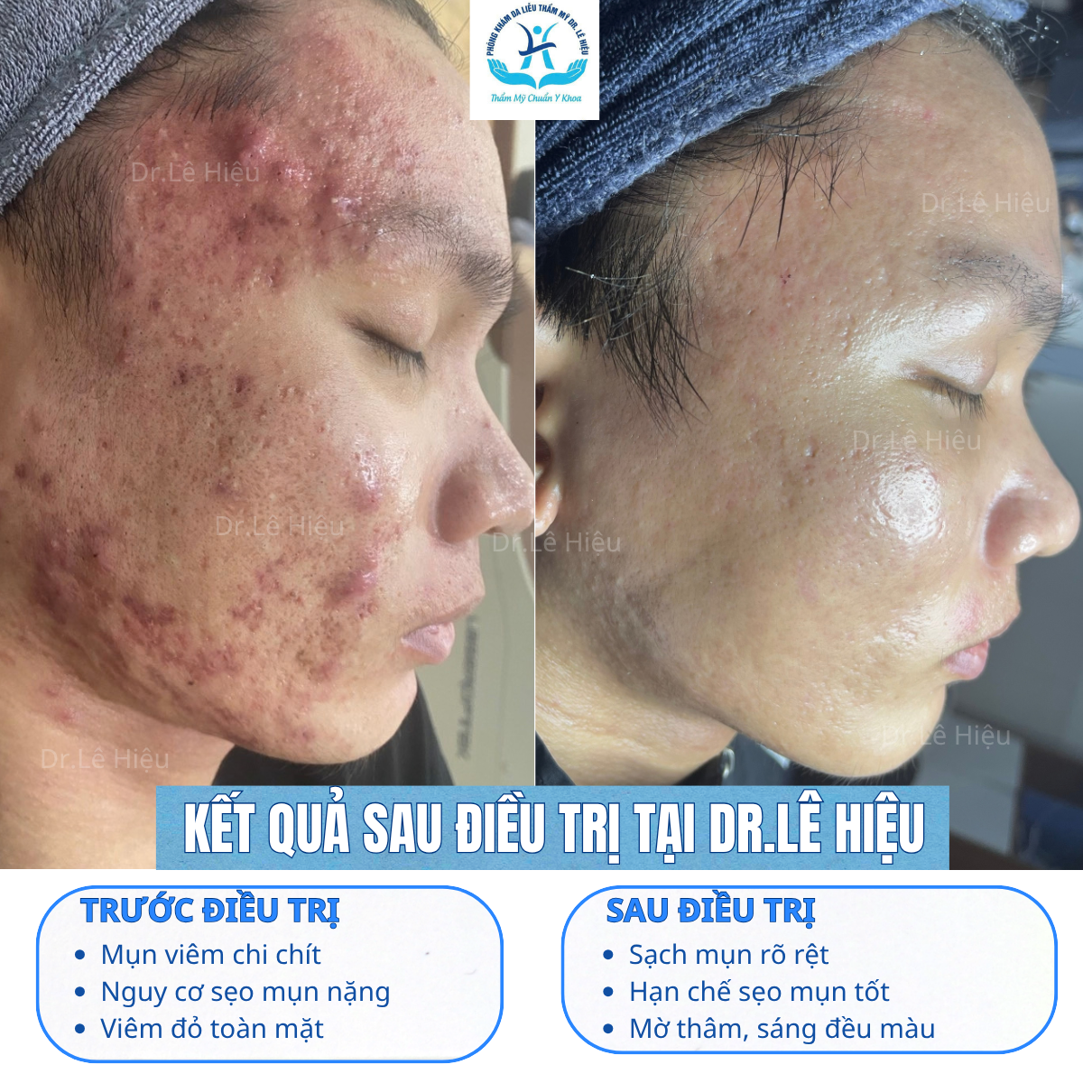 trị mụn tại dr.lê hiệu bình dương
