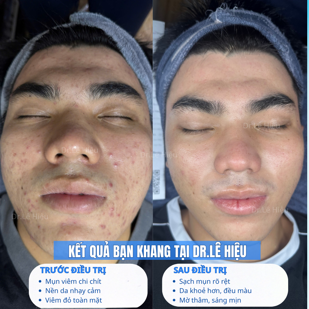 Kết quả sau điều trị mụn viêm tại Dr.Lê Hiệu cơ sở Bình Dương (chính diện)