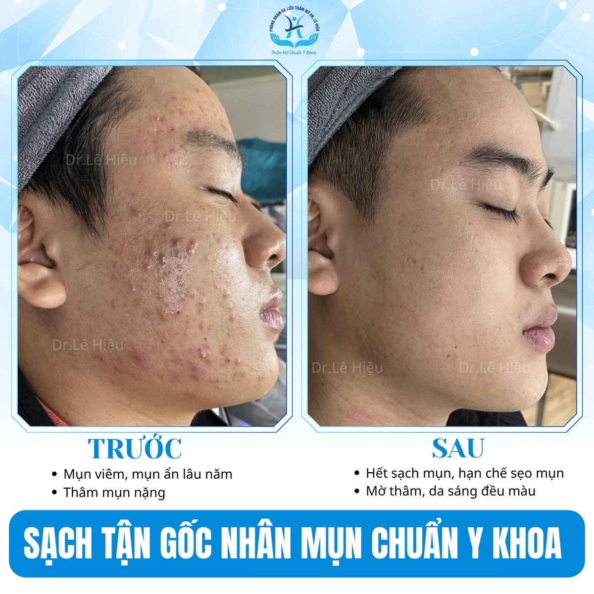 hồ sơ khách điều trị mụn thành công