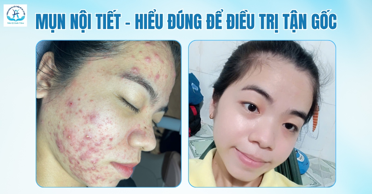 Mụn nội tiết Phòng khám da liễu Dr.Lê Hiệu Bình Dương