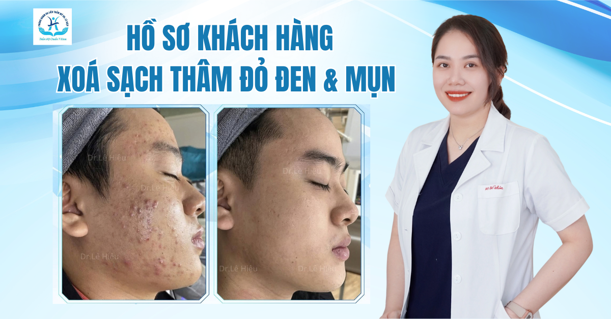 hồ sơ khách hàng điều trị mụn thành công