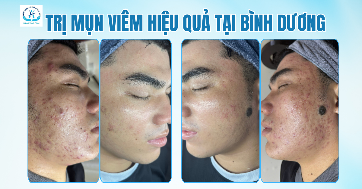 ĐIỀU TRỊ MỤN VIÊM HIỆU QUẢ TẠI BÌNH DƯƠNG