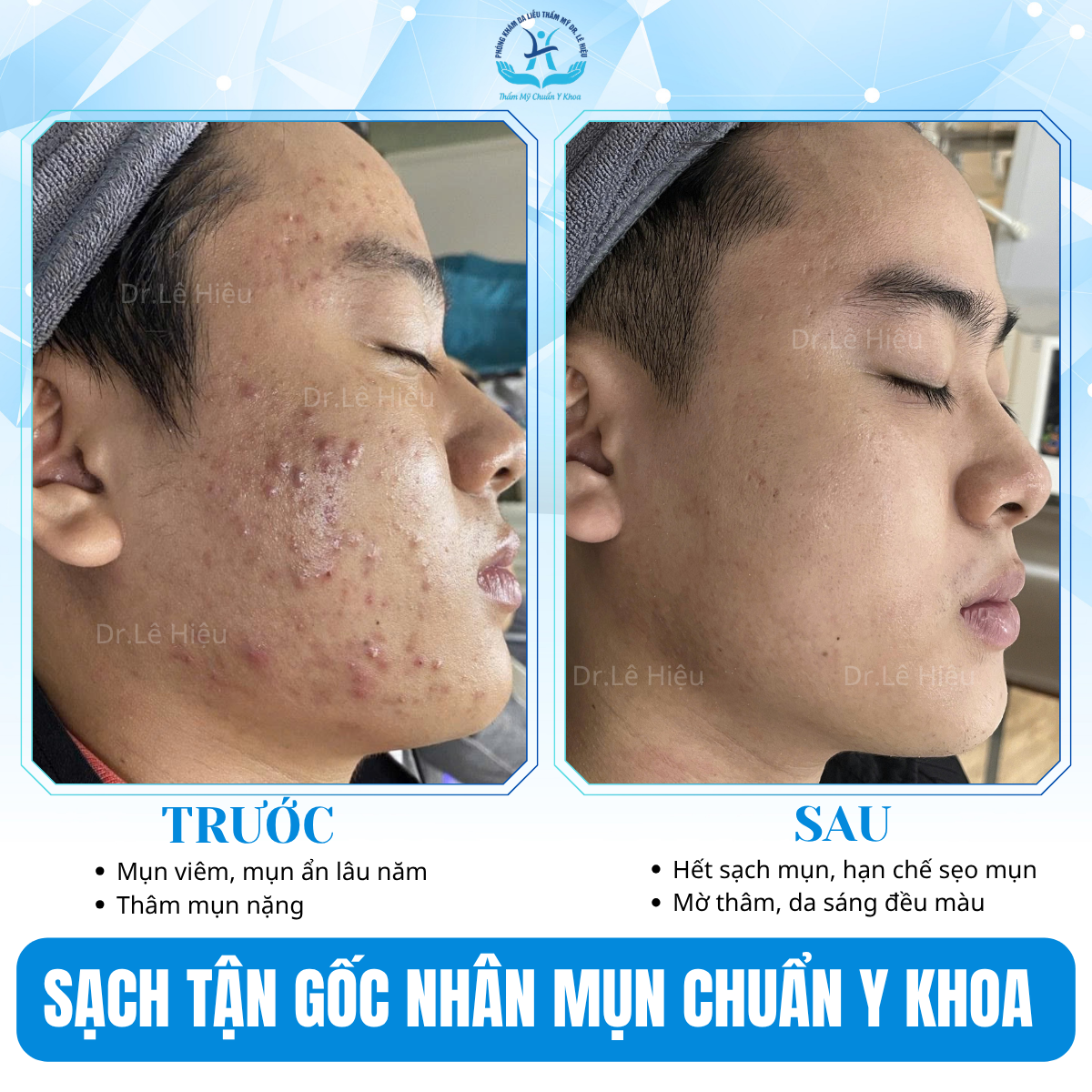 LASER TONING - "CHÌA KHOÁ VÀNG" CẢI THIỆN THÂM MỤN