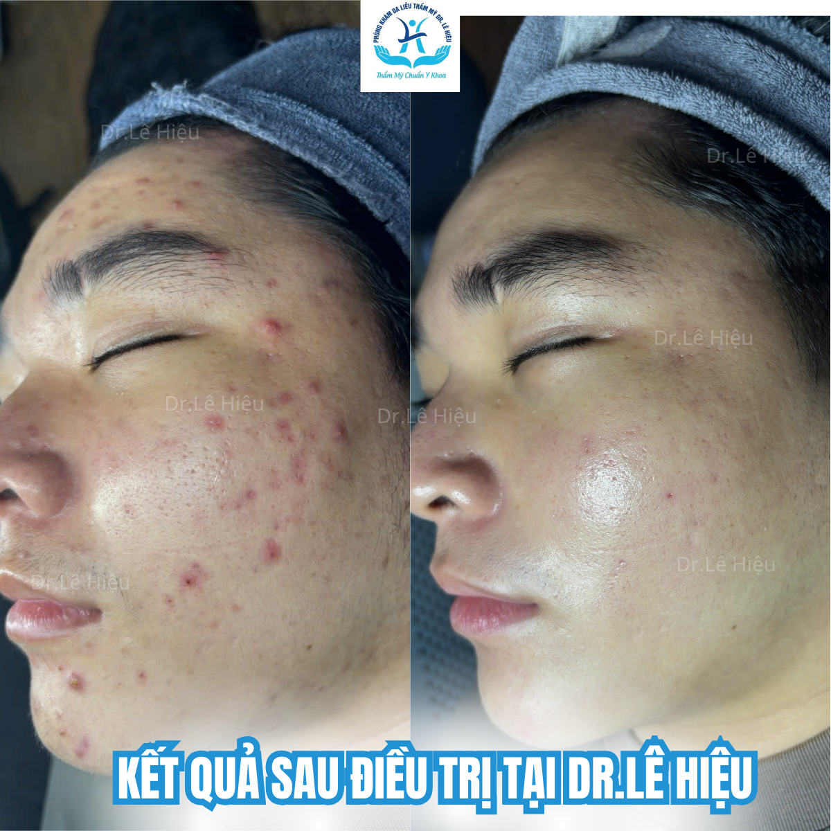 VÌ SAO TRỊ MỤN TỐN CẢ ĐỐNG TIỀN VẪN KHÔNG KHỎI ?