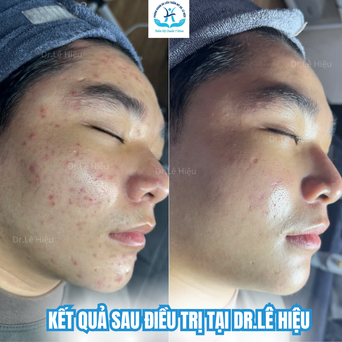 VÌ SAO TRỊ MỤN TỐN CẢ ĐỐNG TIỀN VẪN KHÔNG KHỎI ?