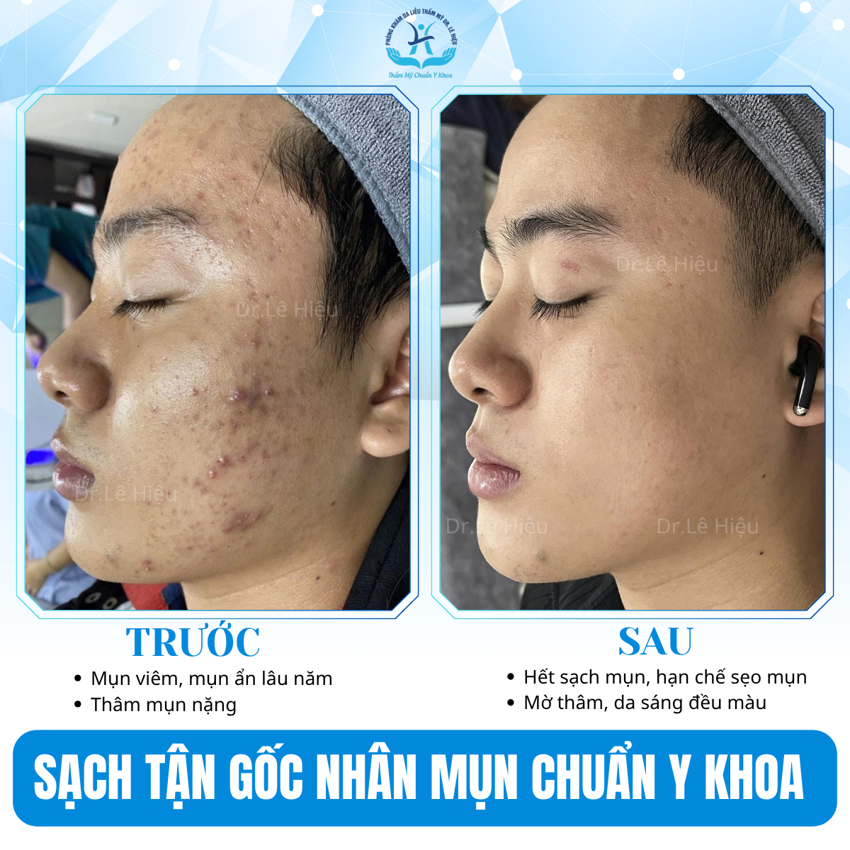 LASER TONING - "CHÌA KHOÁ VÀNG" CẢI THIỆN THÂM MỤN