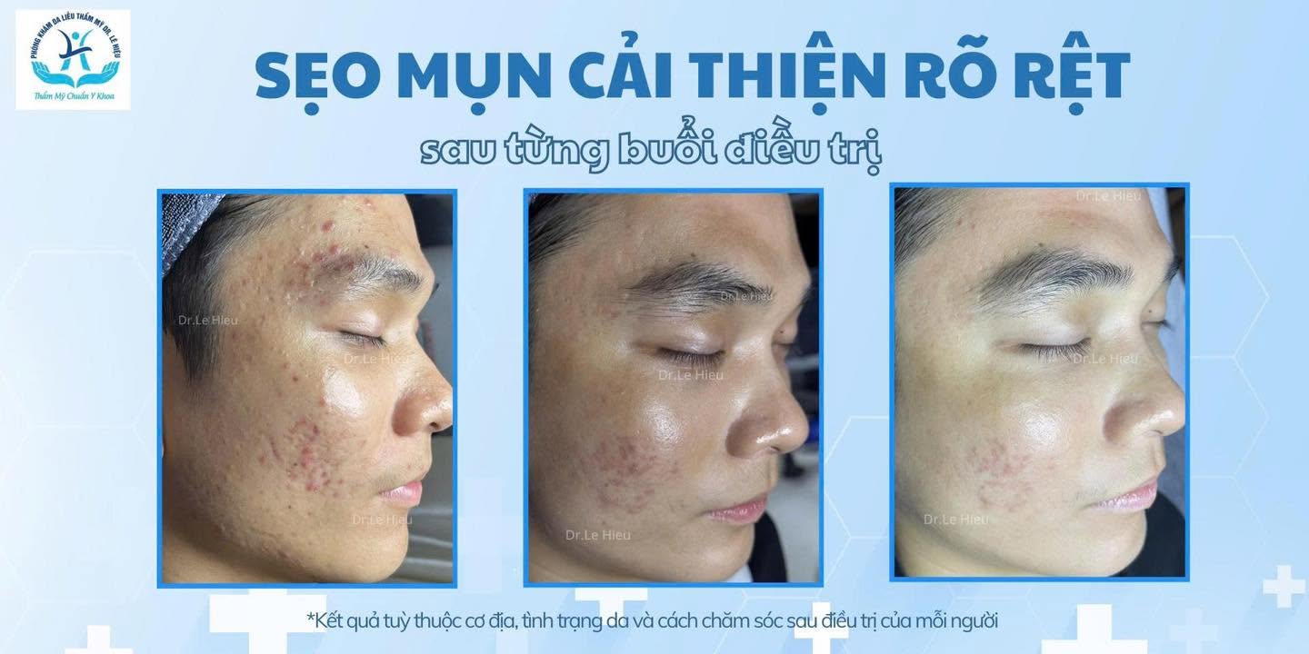 điều trị sẹo rỗ hiệu quả ở dr.lê hiệu bình dương