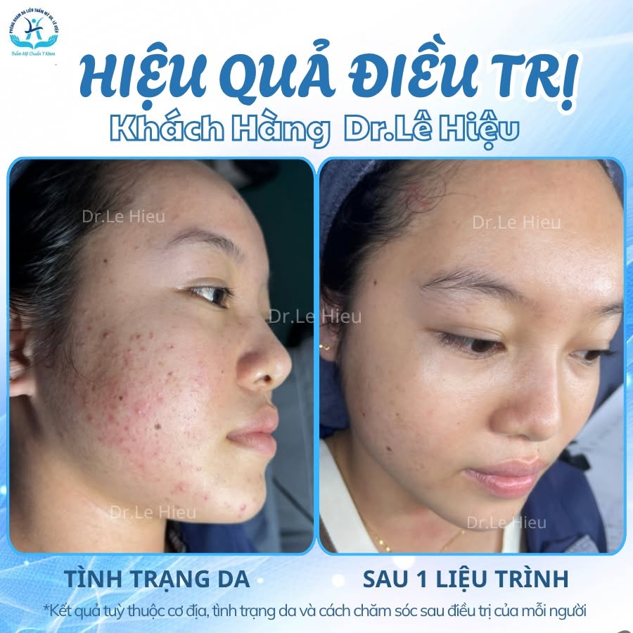 LASER TONING - "CHÌA KHOÁ VÀNG" CẢI THIỆN THÂM MỤN