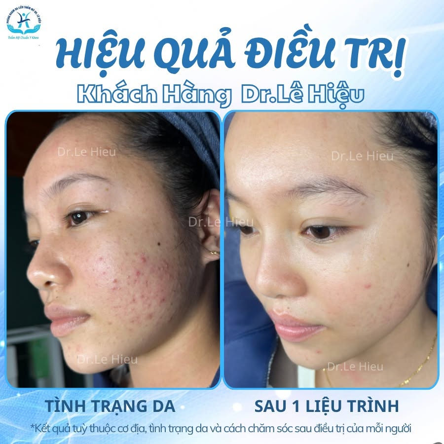LASER TONING - "CHÌA KHOÁ VÀNG" CẢI THIỆN THÂM MỤN
