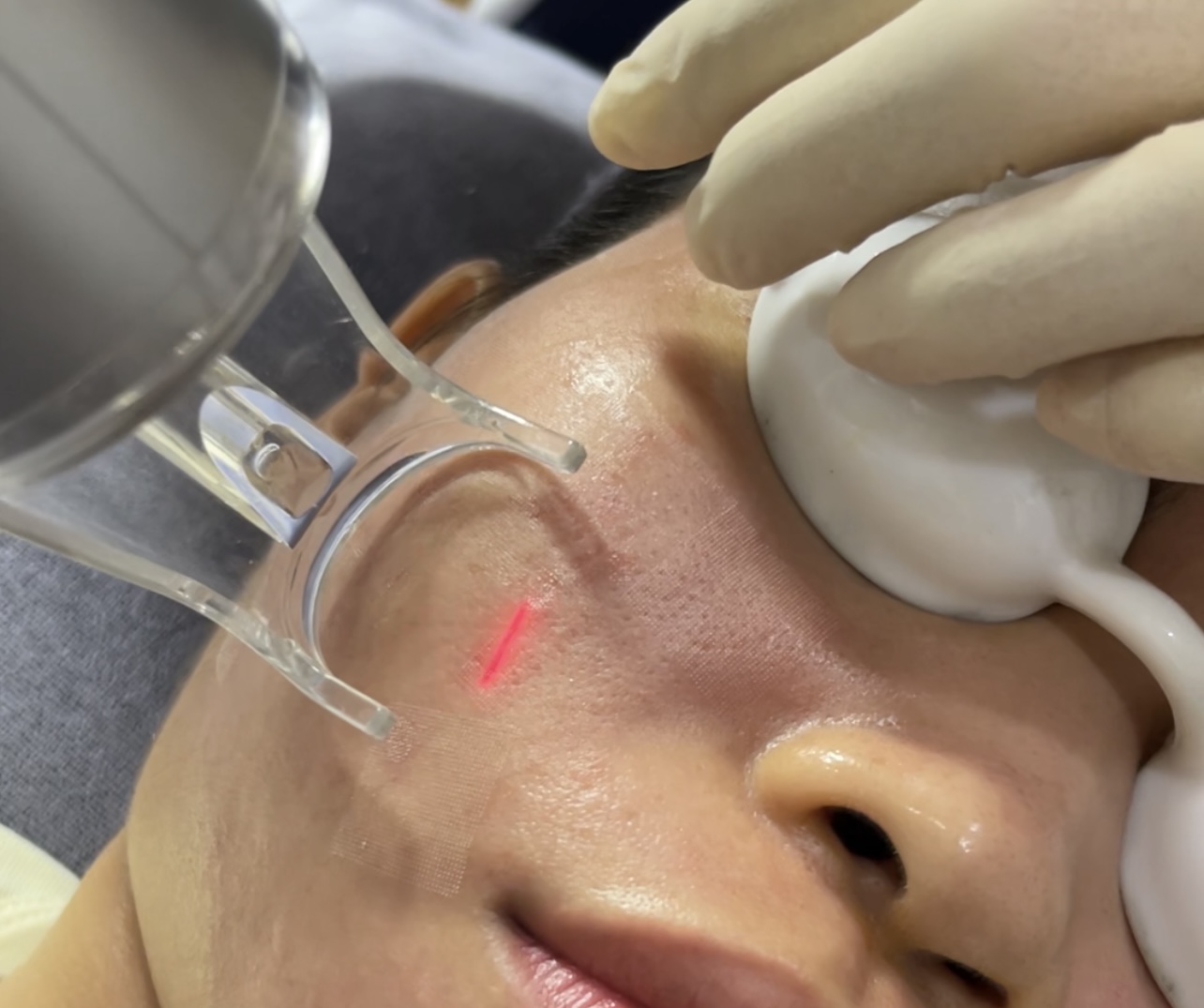 điều trị sẹo rỗ hiệu quả ở dr.lê hiệu bình dương