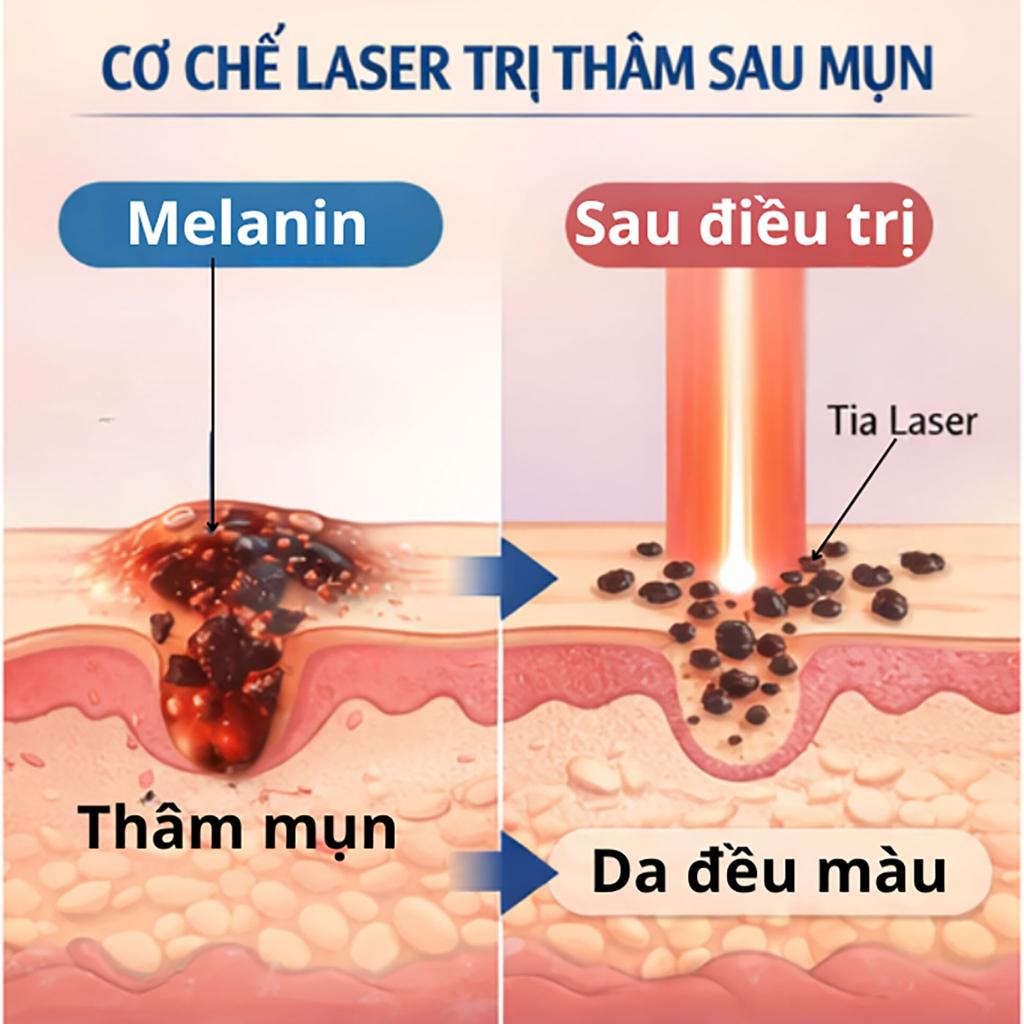 Laser toning điều trị thâm mụn 